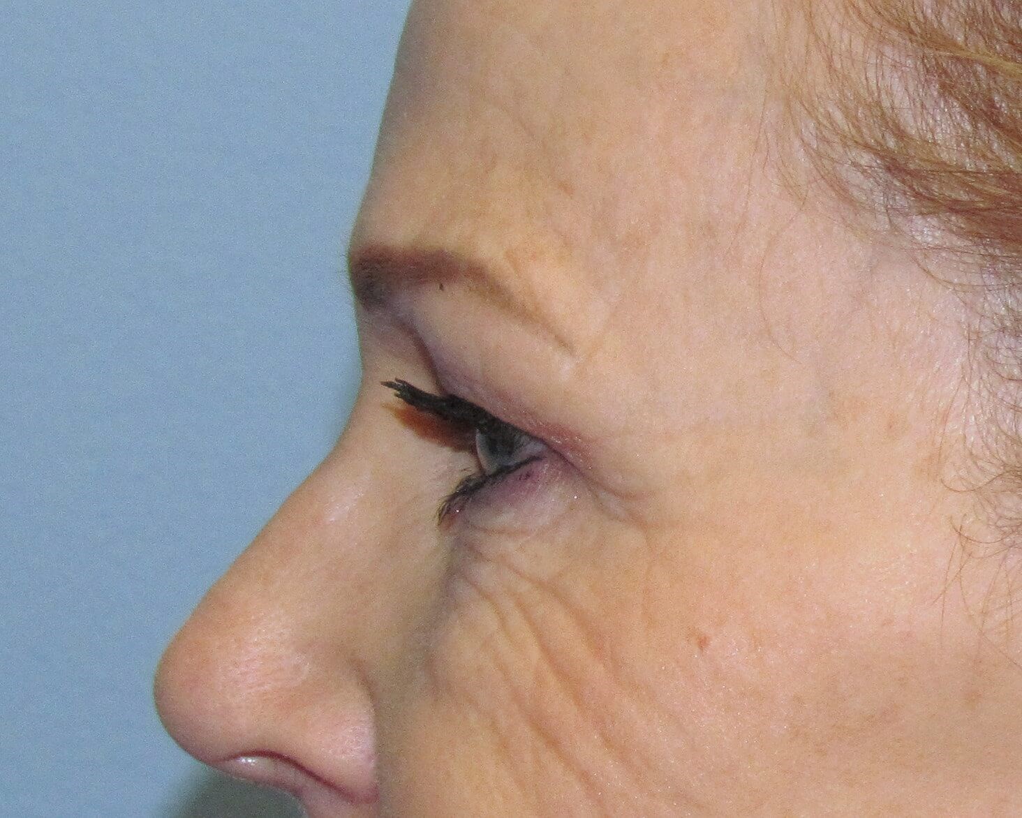 Brow lift and Blepharoplasty Before Brow Lift & Eyelid Lift