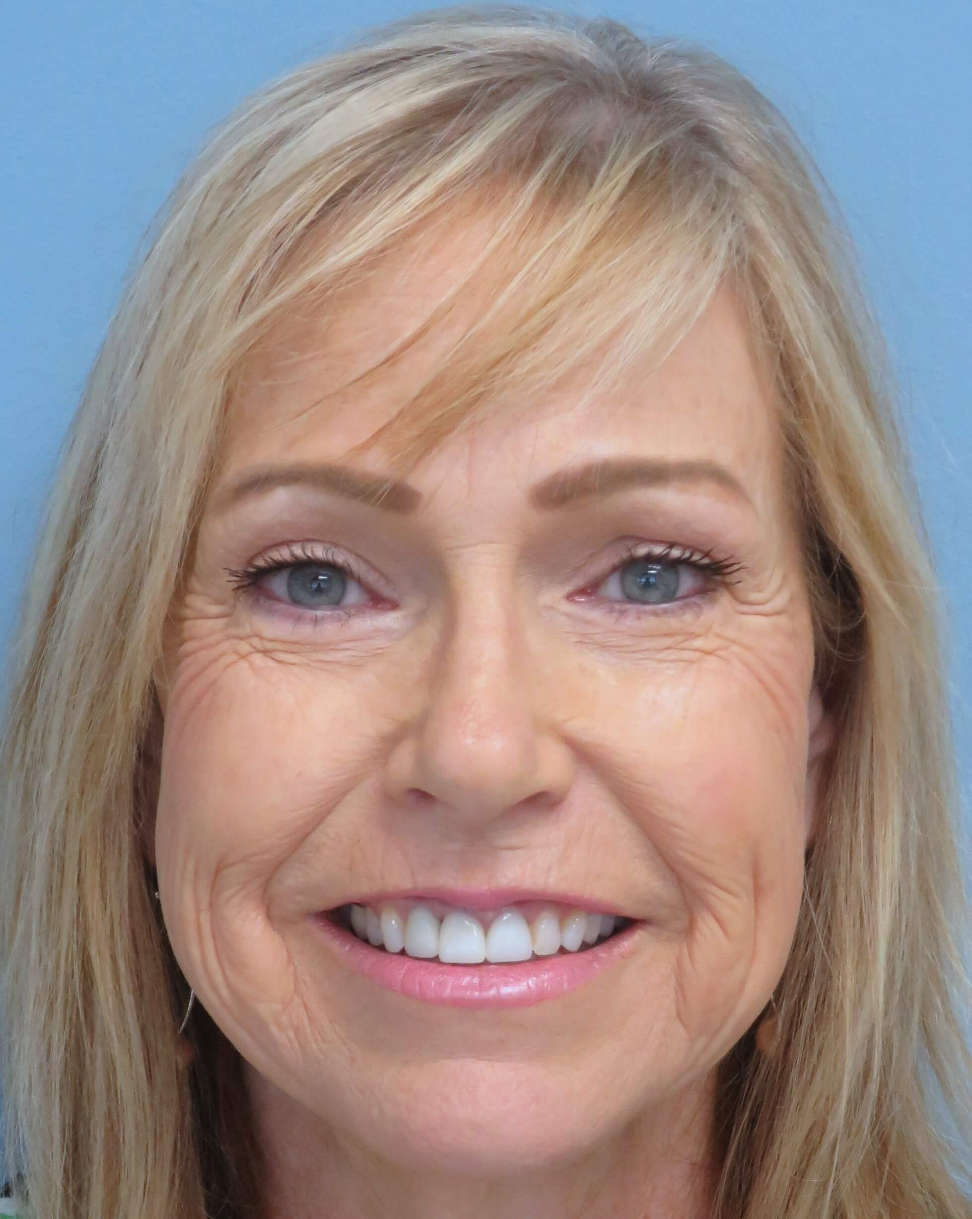 Brow lift and Blepharoplasty After Brow Lift & Eyelid Lift