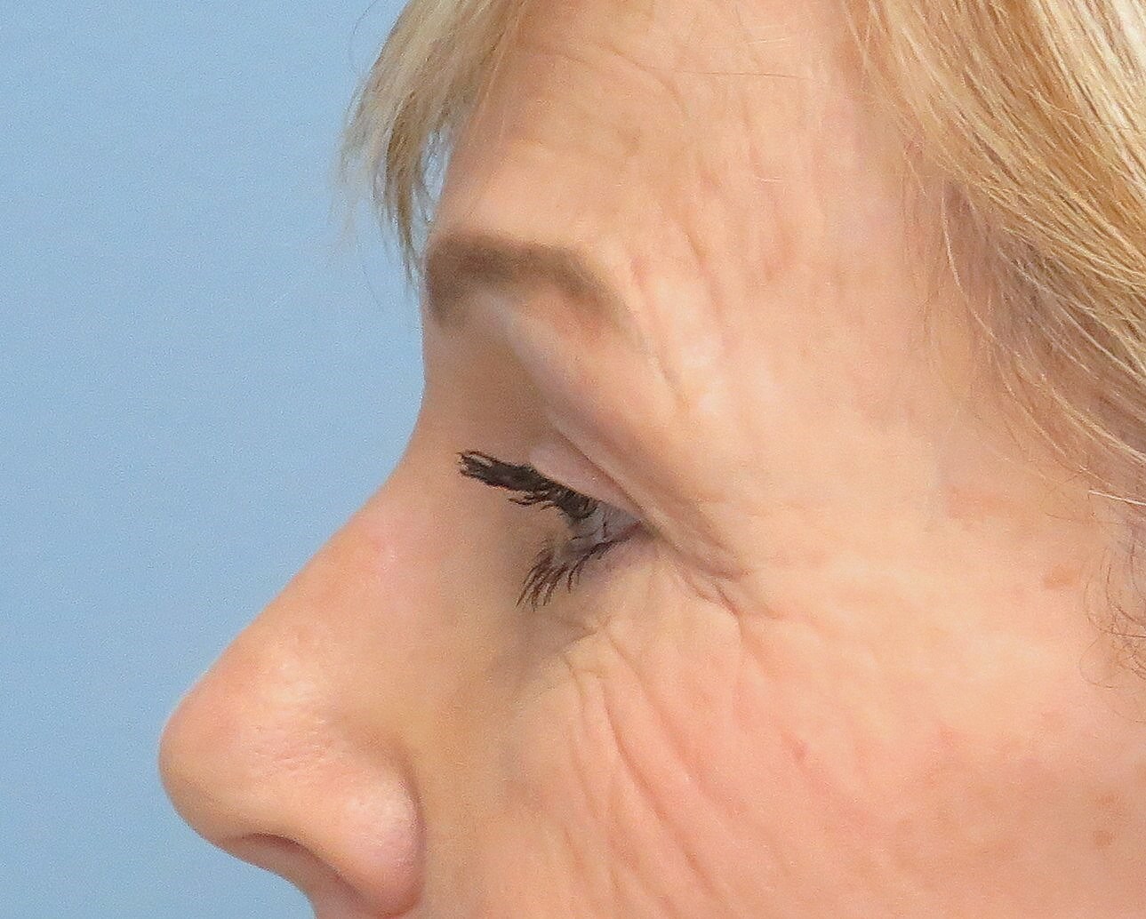 Brow lift and Blepharoplasty After Brow Lift & Eyelid Lift