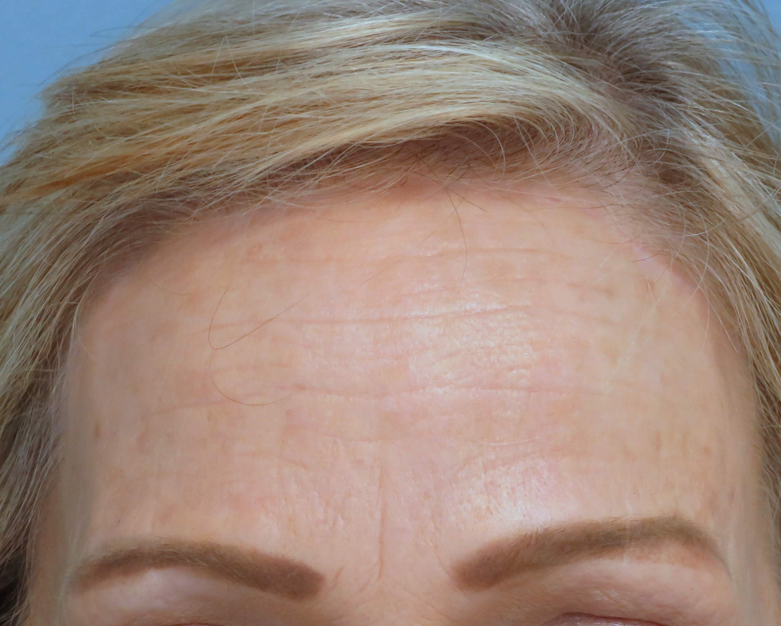 Brow lift and Blepharoplasty After Brow Lift & Eyelid Lift