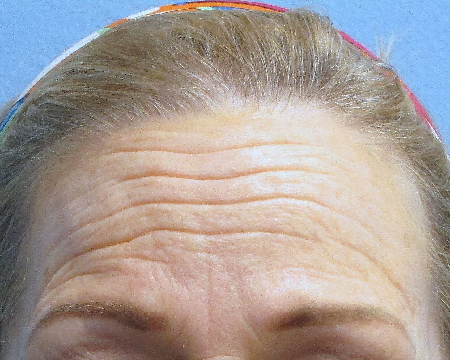 Brow lift and Blepharoplasty Before Brow Lift & Eyelid Lift