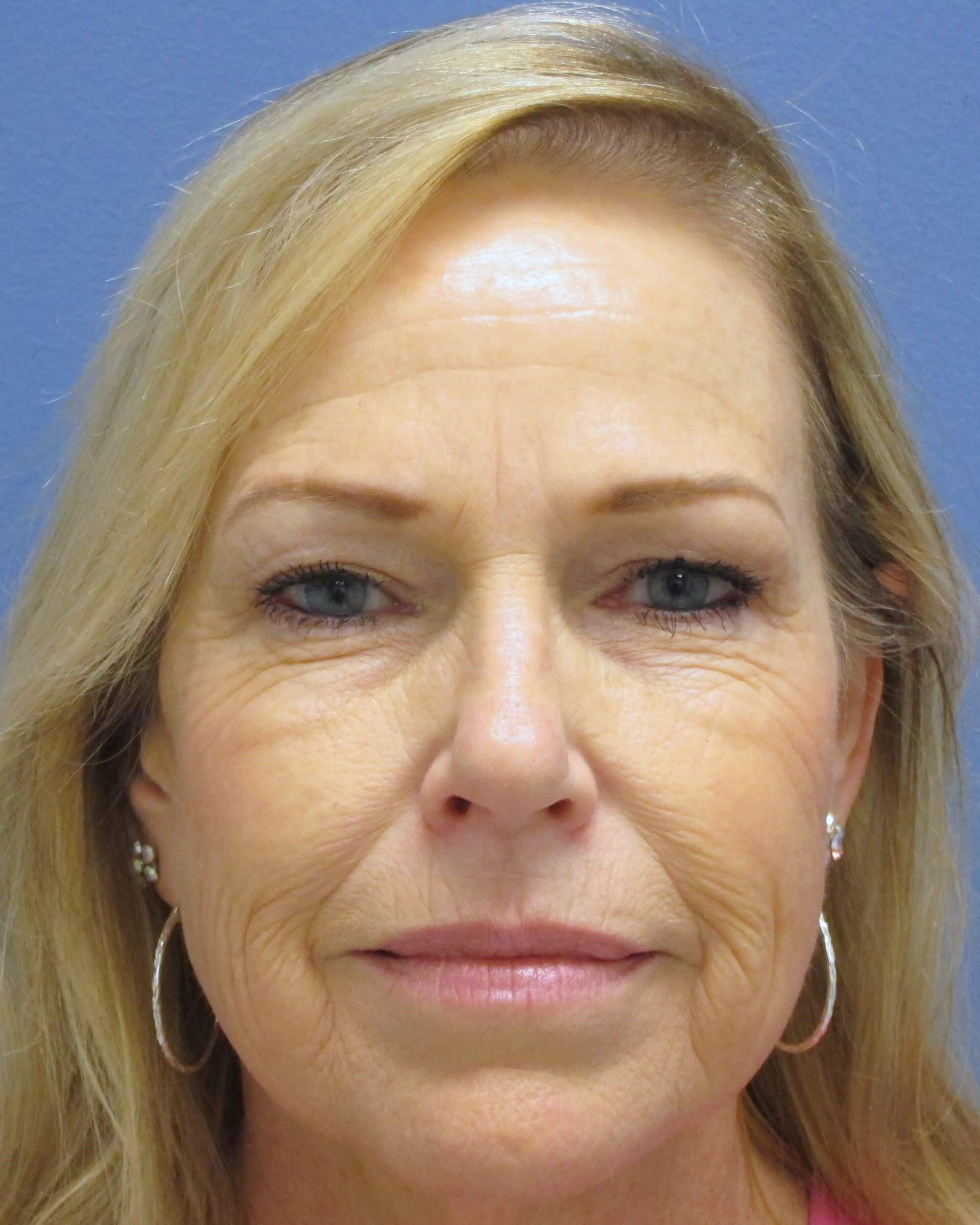 Brow lift and Blepharoplasty Before Brow Lift & Eyelid Lift