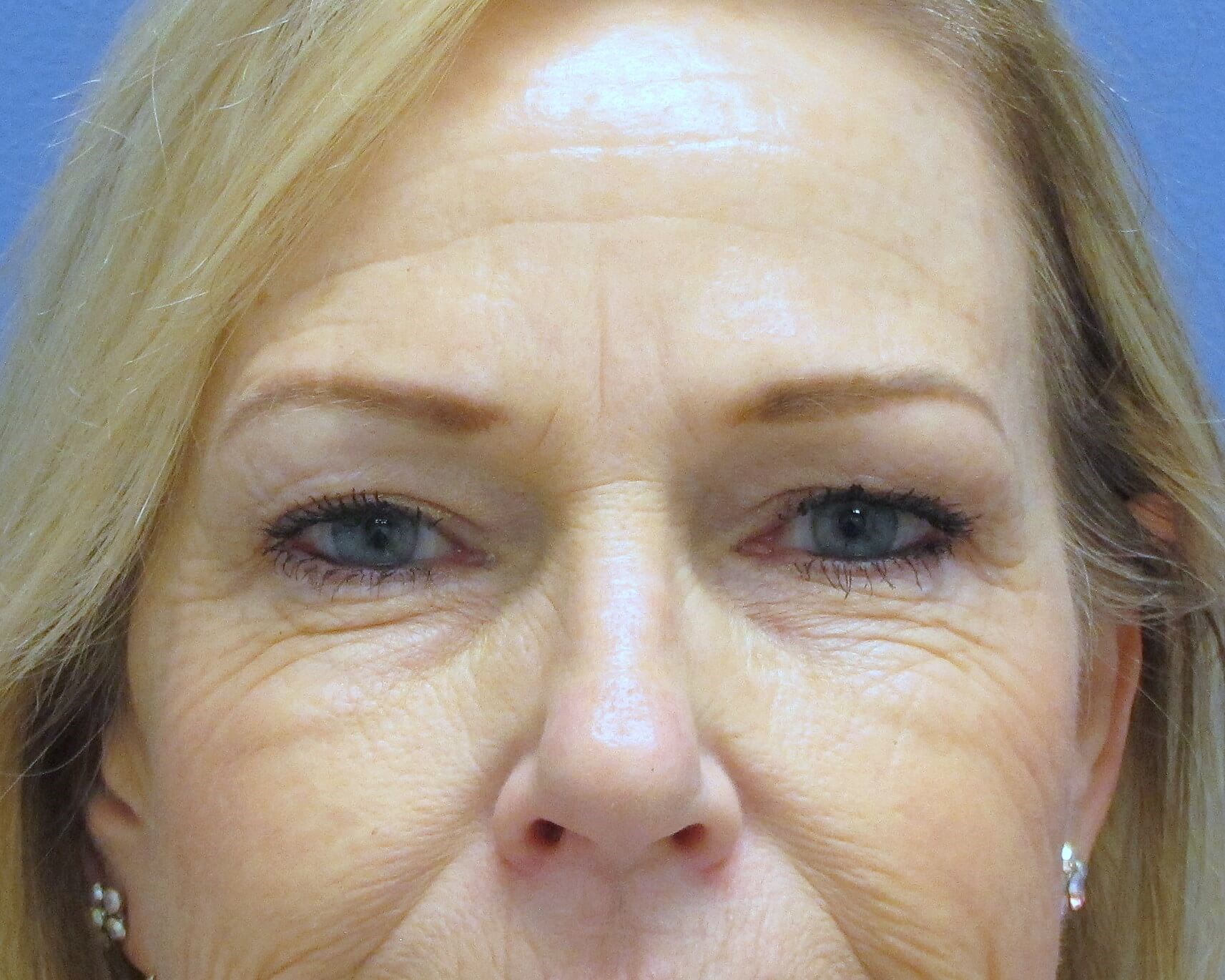 Brow lift and Blepharoplasty Before Brow Lift & Eyelid Lift