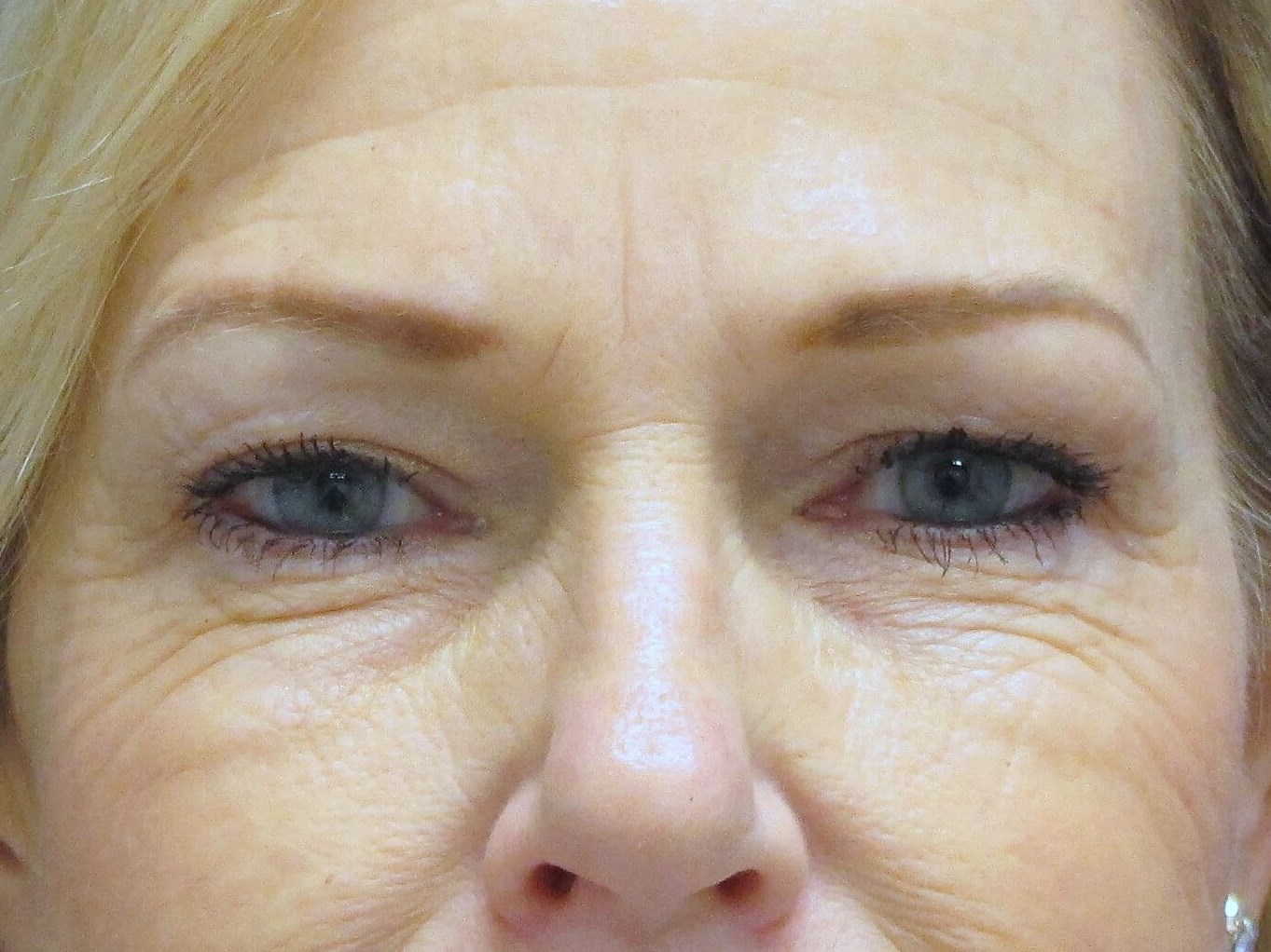 Brow lift and Blepharoplasty Before Brow Lift & Eyelid Lift