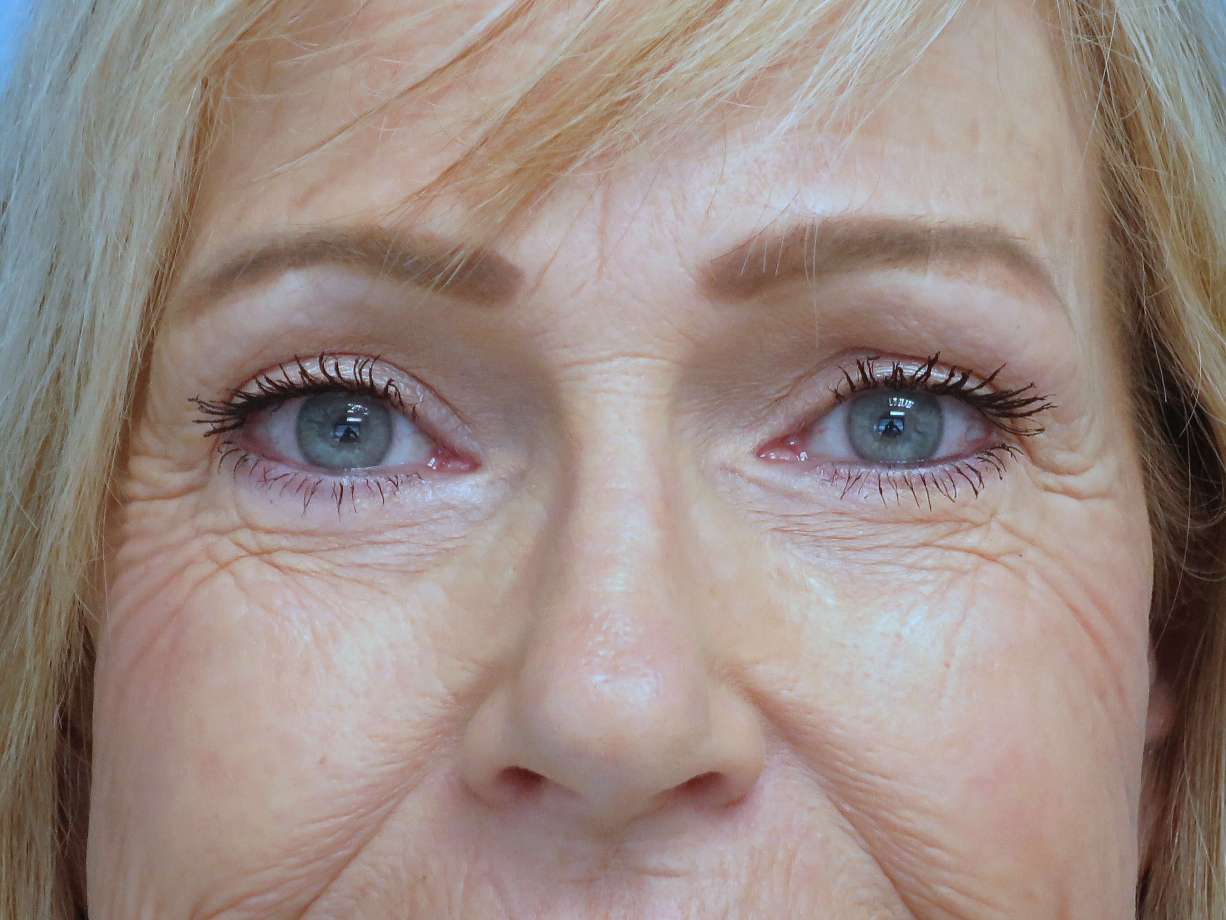 Brow lift and Blepharoplasty After Brow Lift & Eyelid Lift