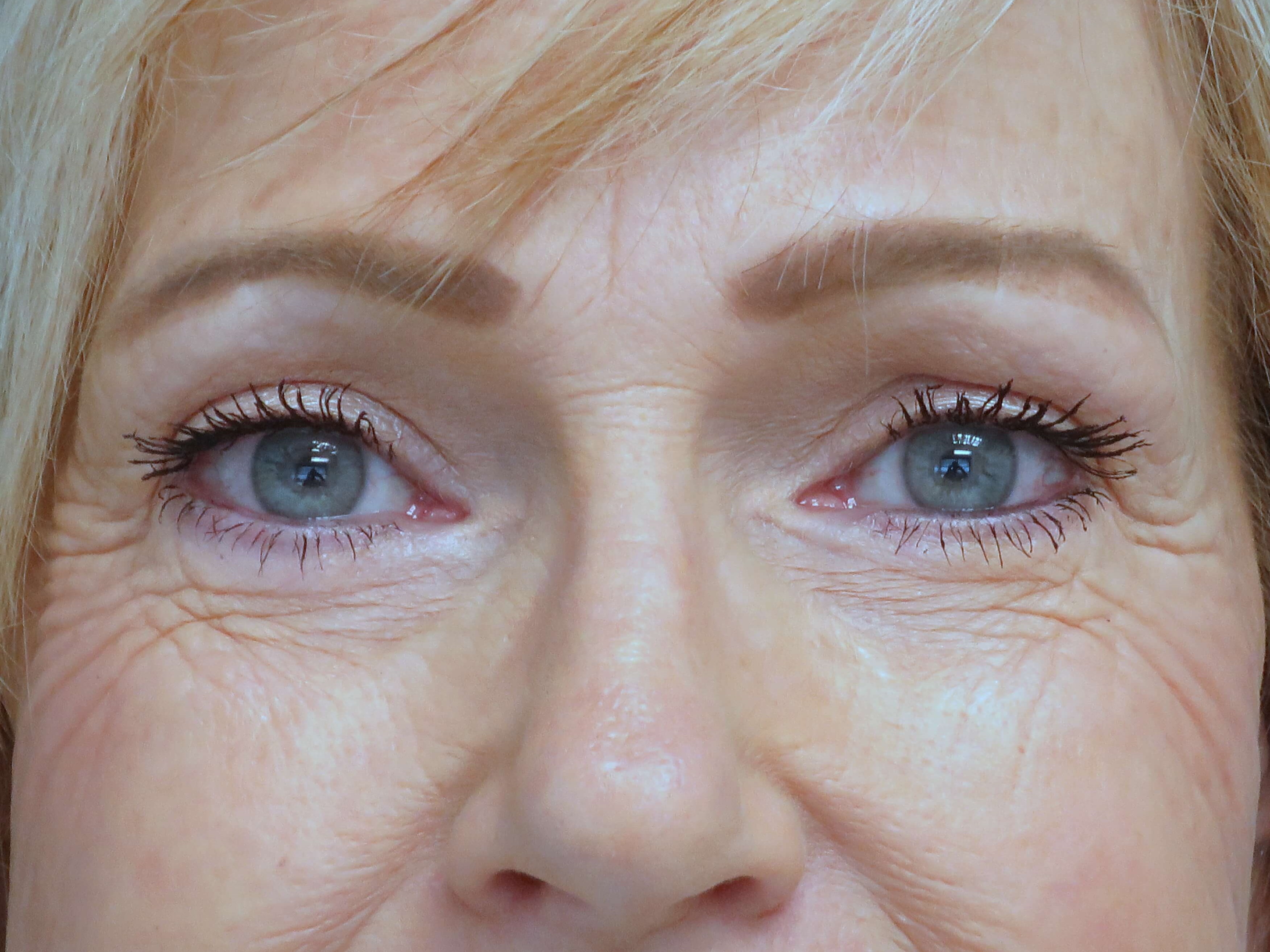 Brow lift and Blepharoplasty After Brow Lift & Eyelid Lift