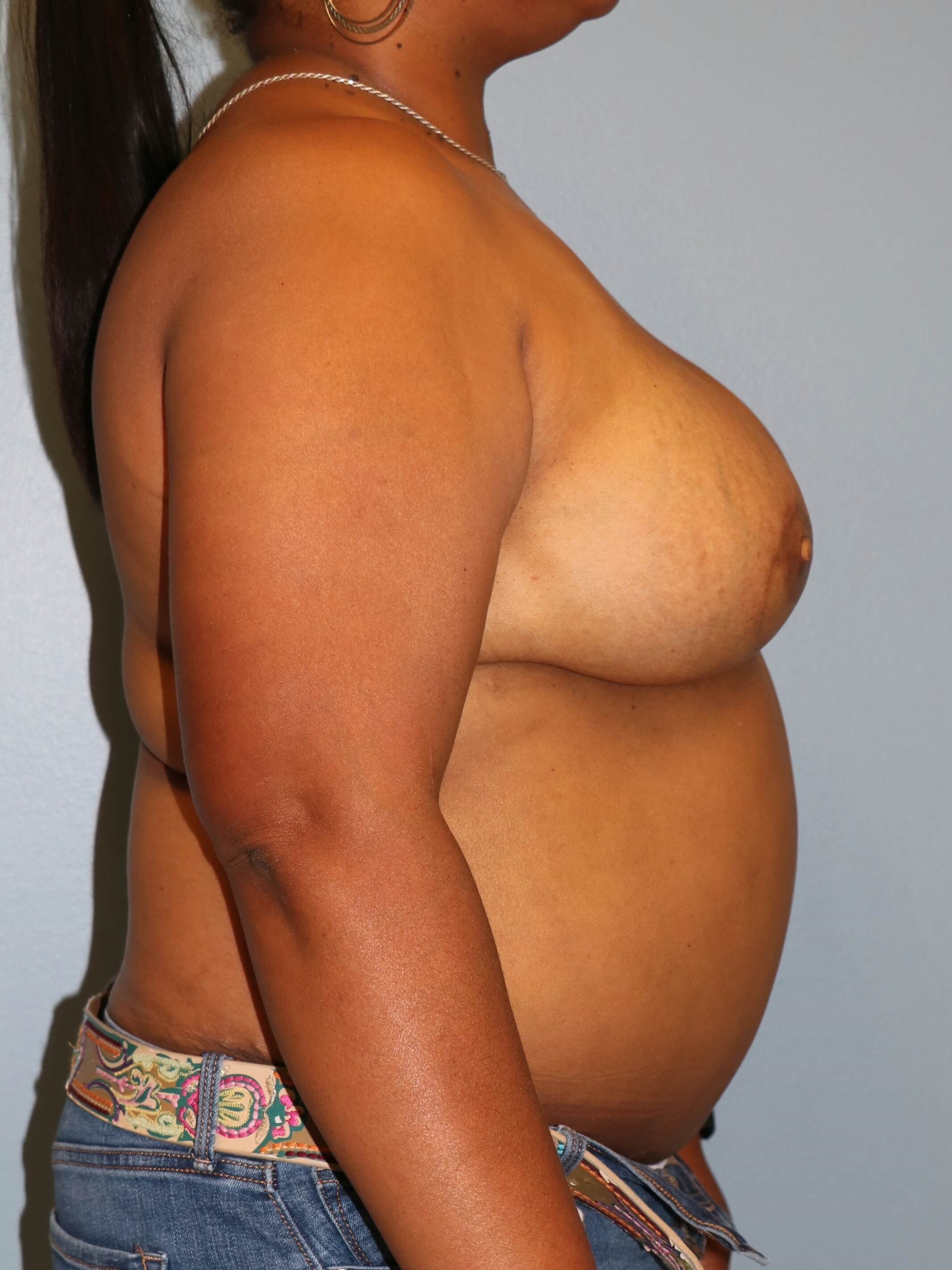 BRCA DIEP Flap Reconstruction After Bilateral DIEP Flaps