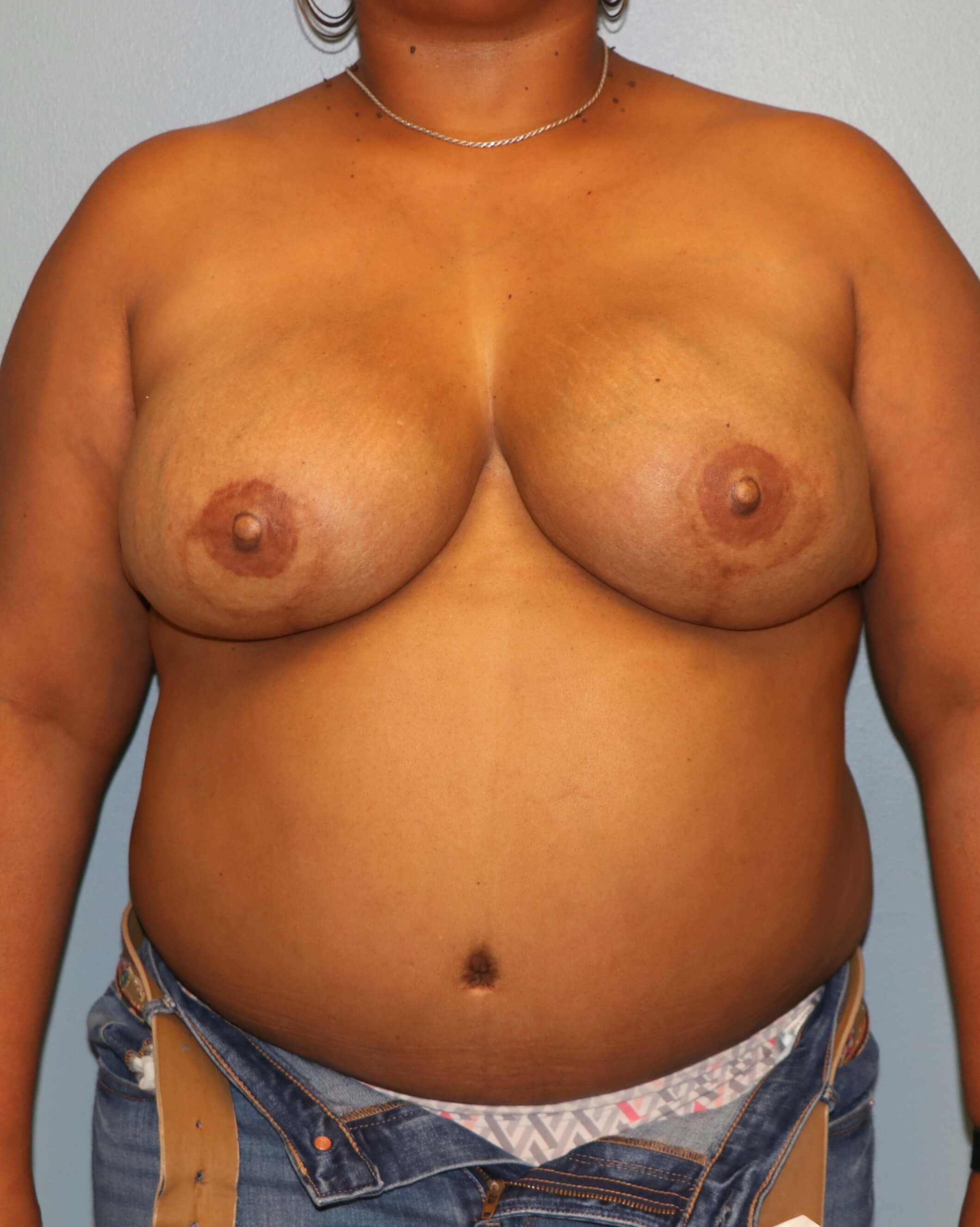 BRCA DIEP Flap Reconstruction After Bilateral DIEP Flaps