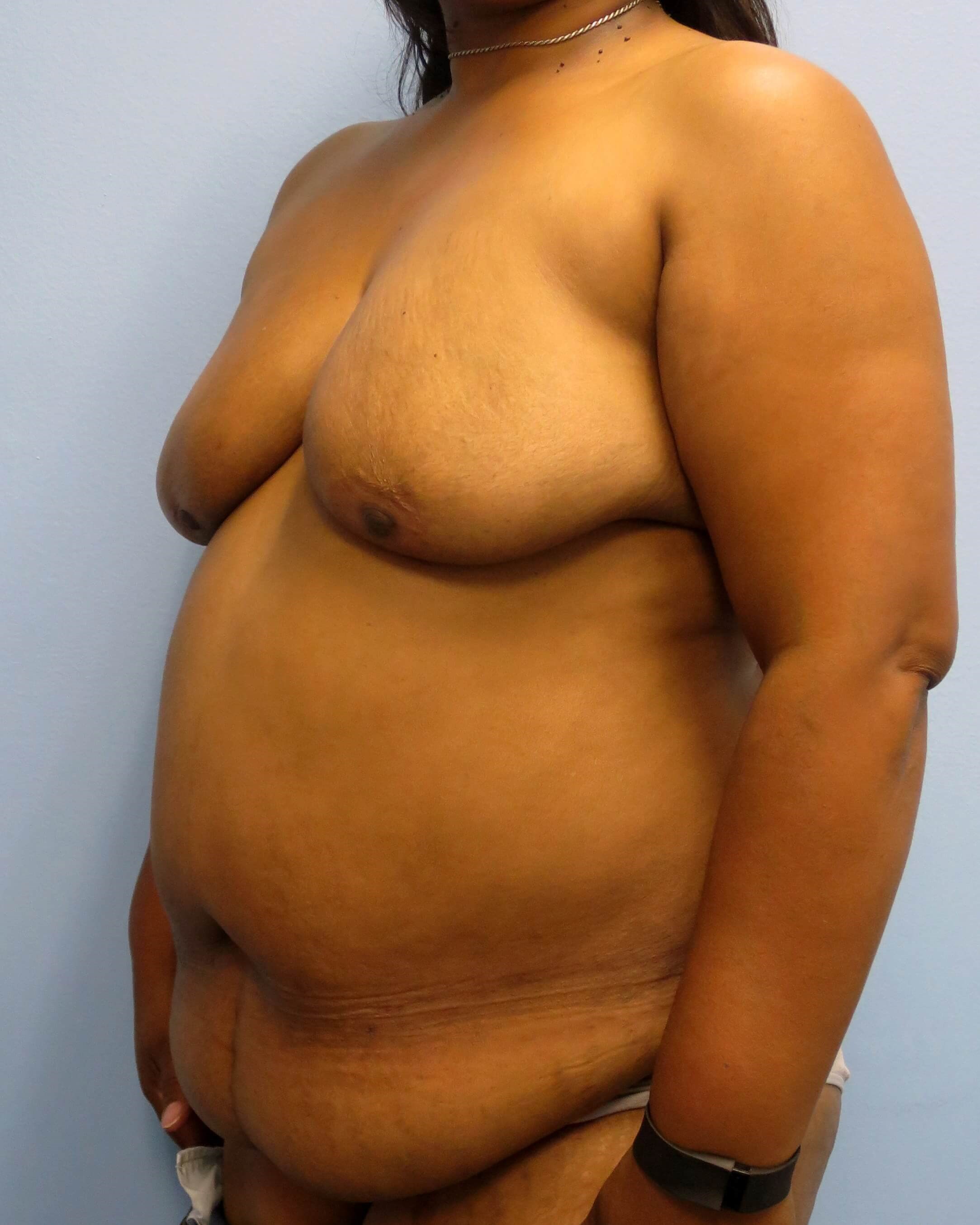 BRCA DIEP Flap Reconstruction Before Bilateral DIEP Flaps
