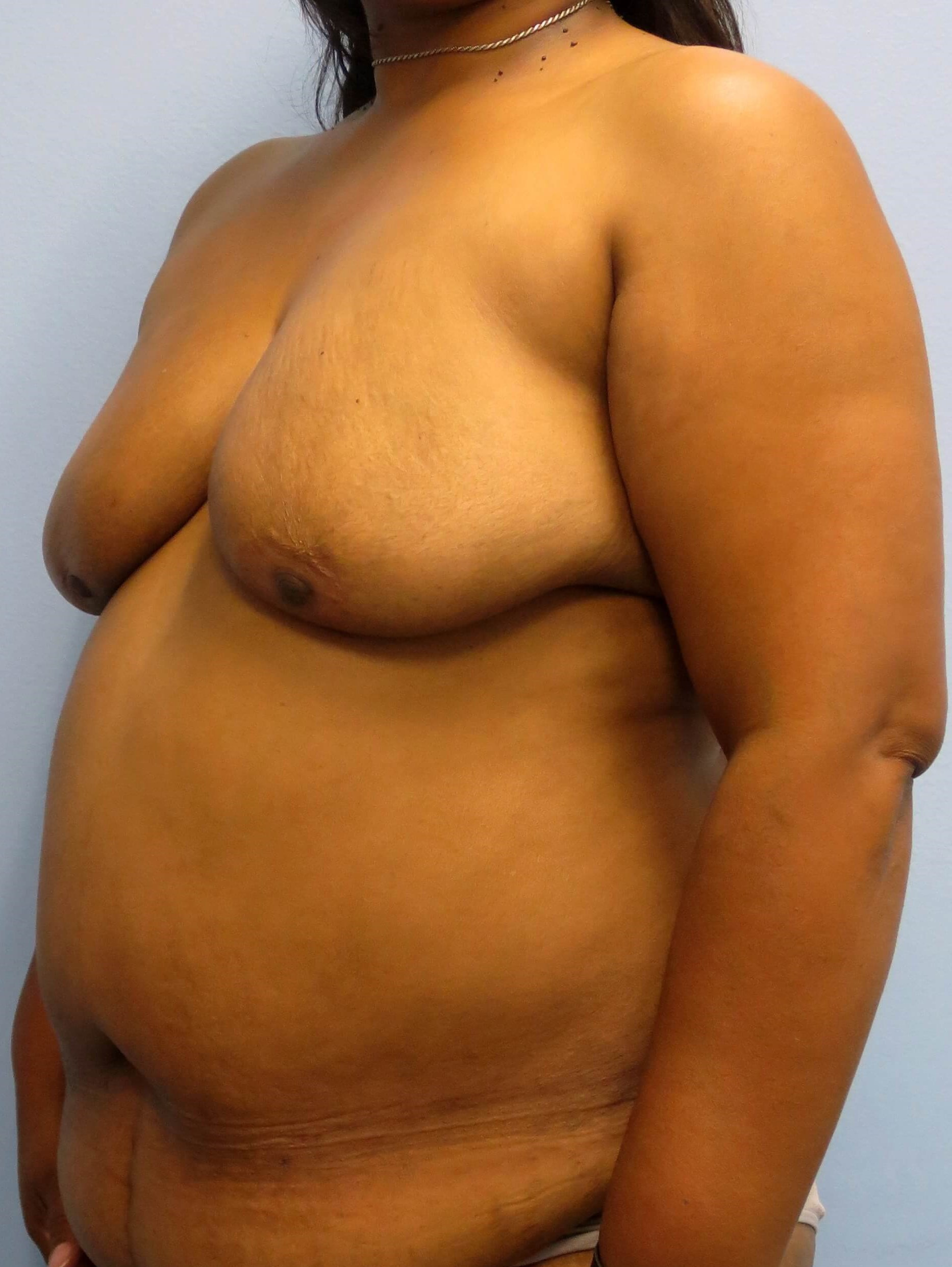 BRCA DIEP Flap Reconstruction Before Bilateral DIEP Flaps
