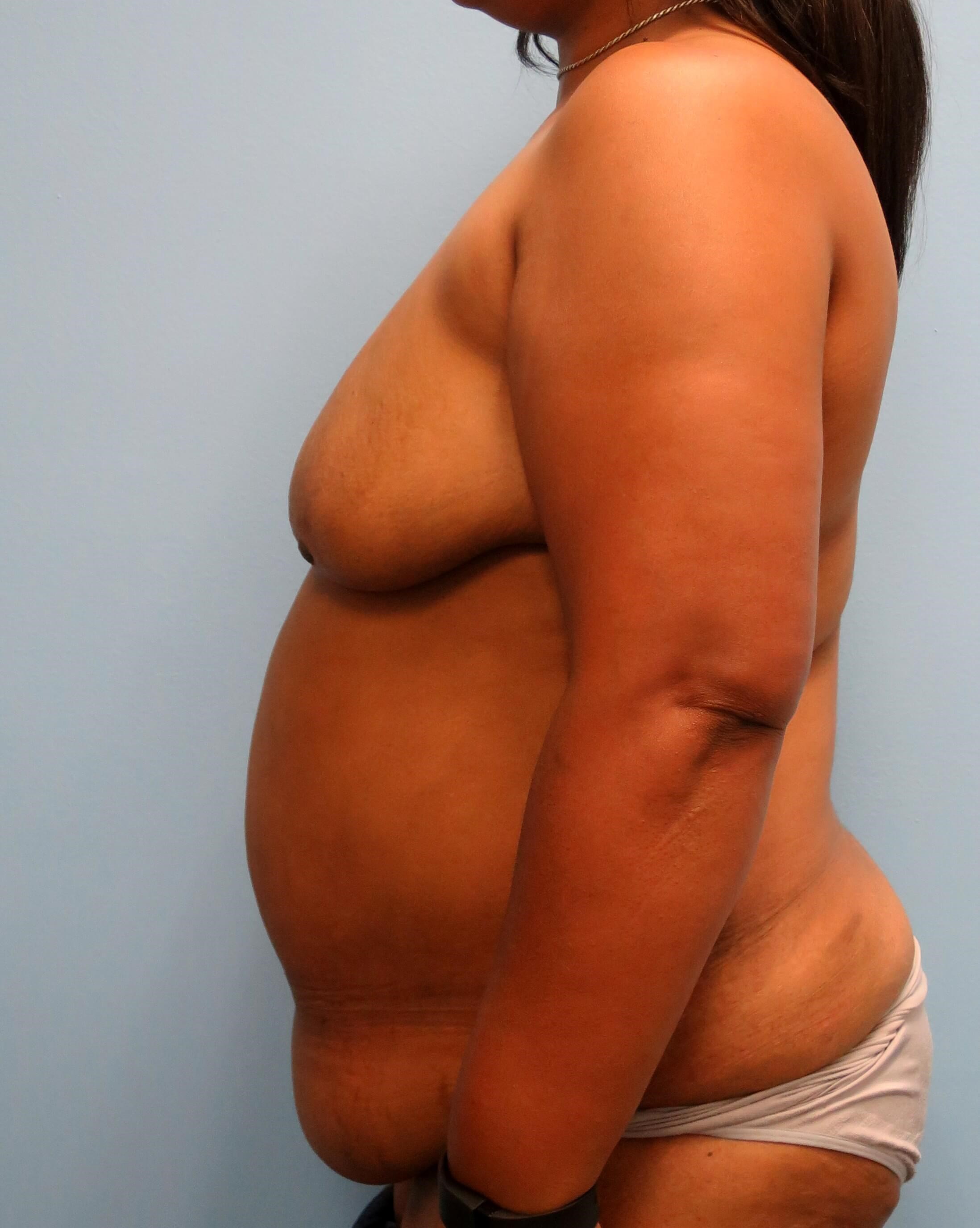 BRCA DIEP Flap Reconstruction Before Bilateral DIEP Flaps