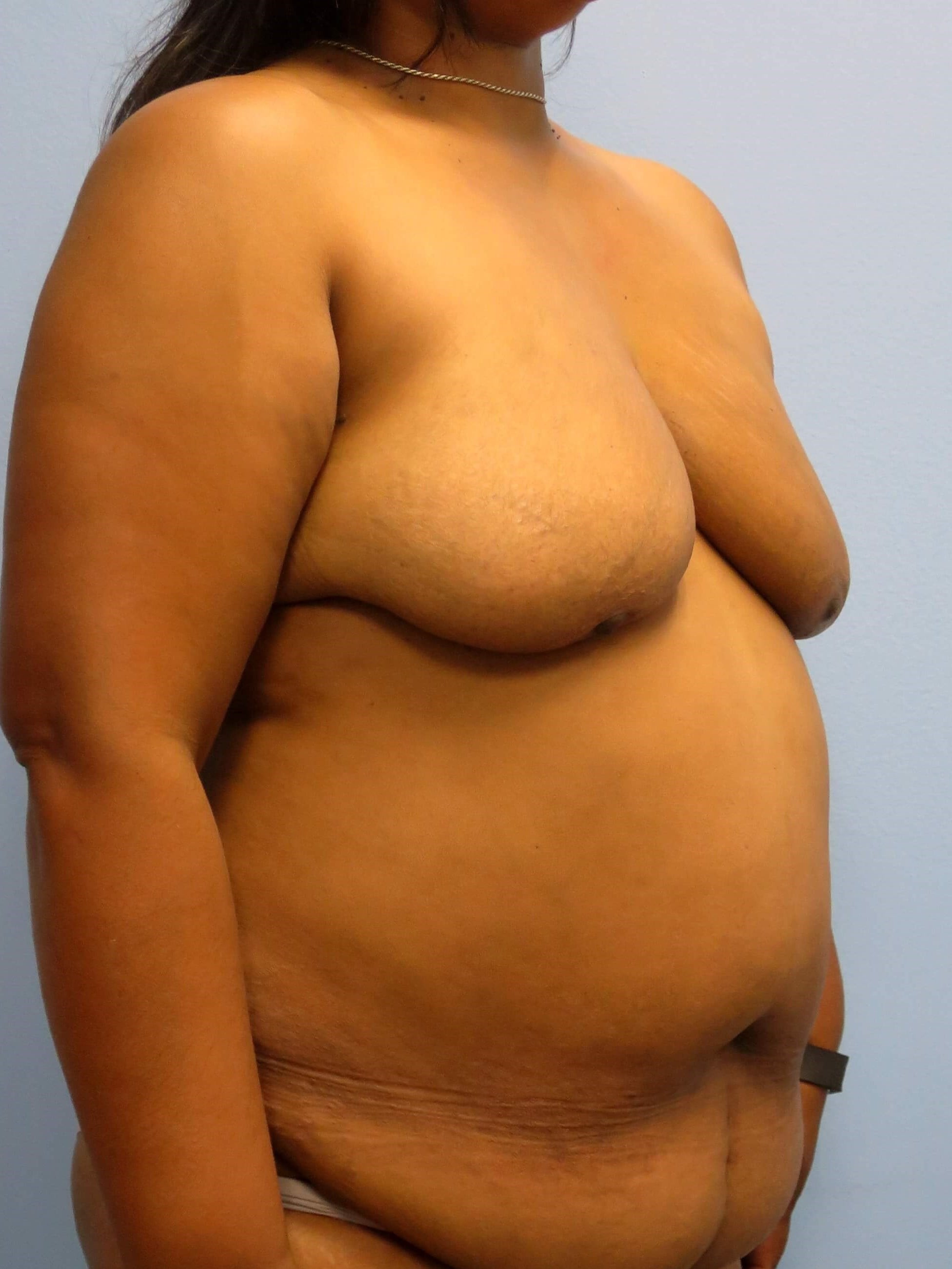 BRCA DIEP Flap Reconstruction Before Bilateral DIEP Flaps