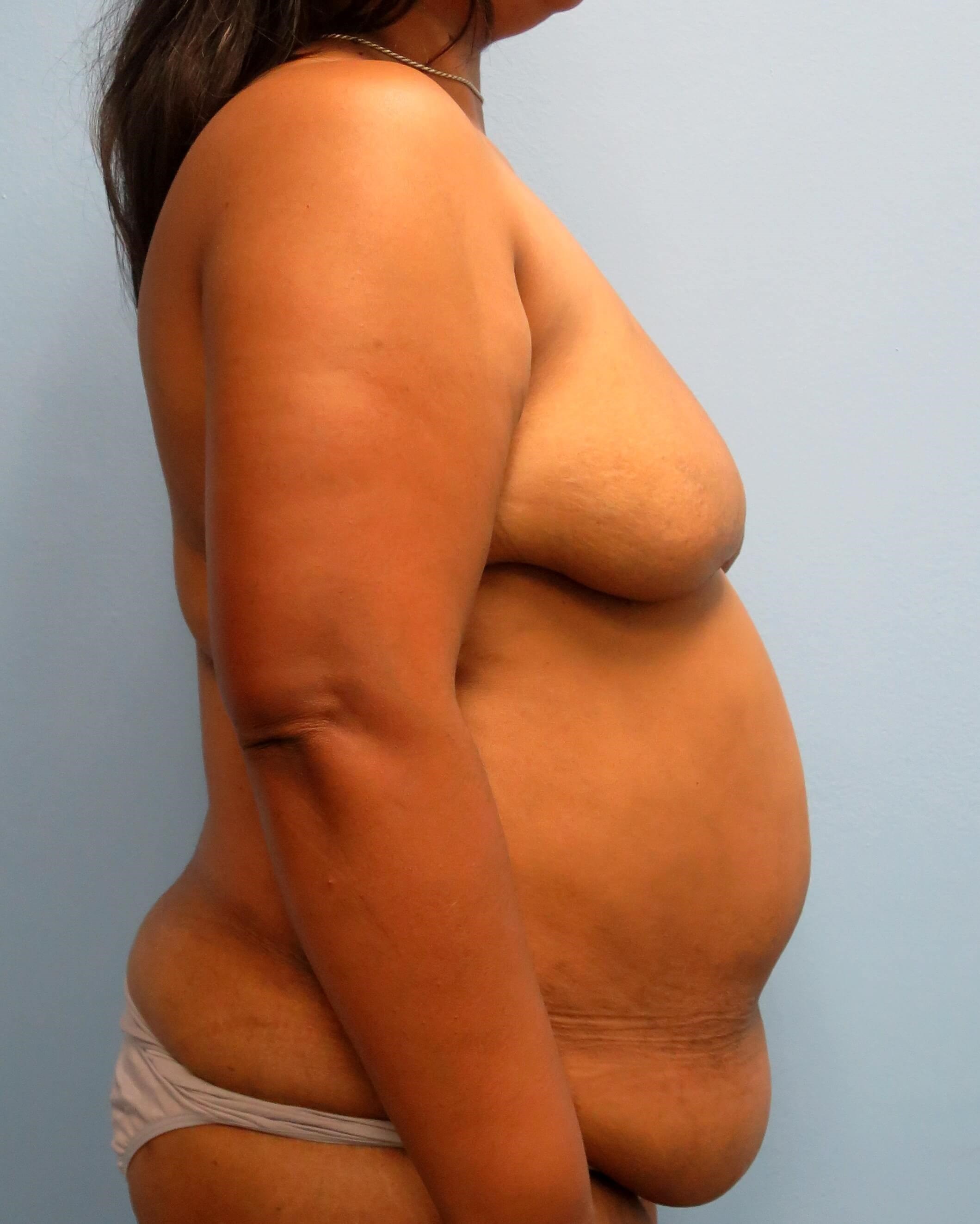 BRCA DIEP Flap Reconstruction Before Bilateral DIEP Flaps