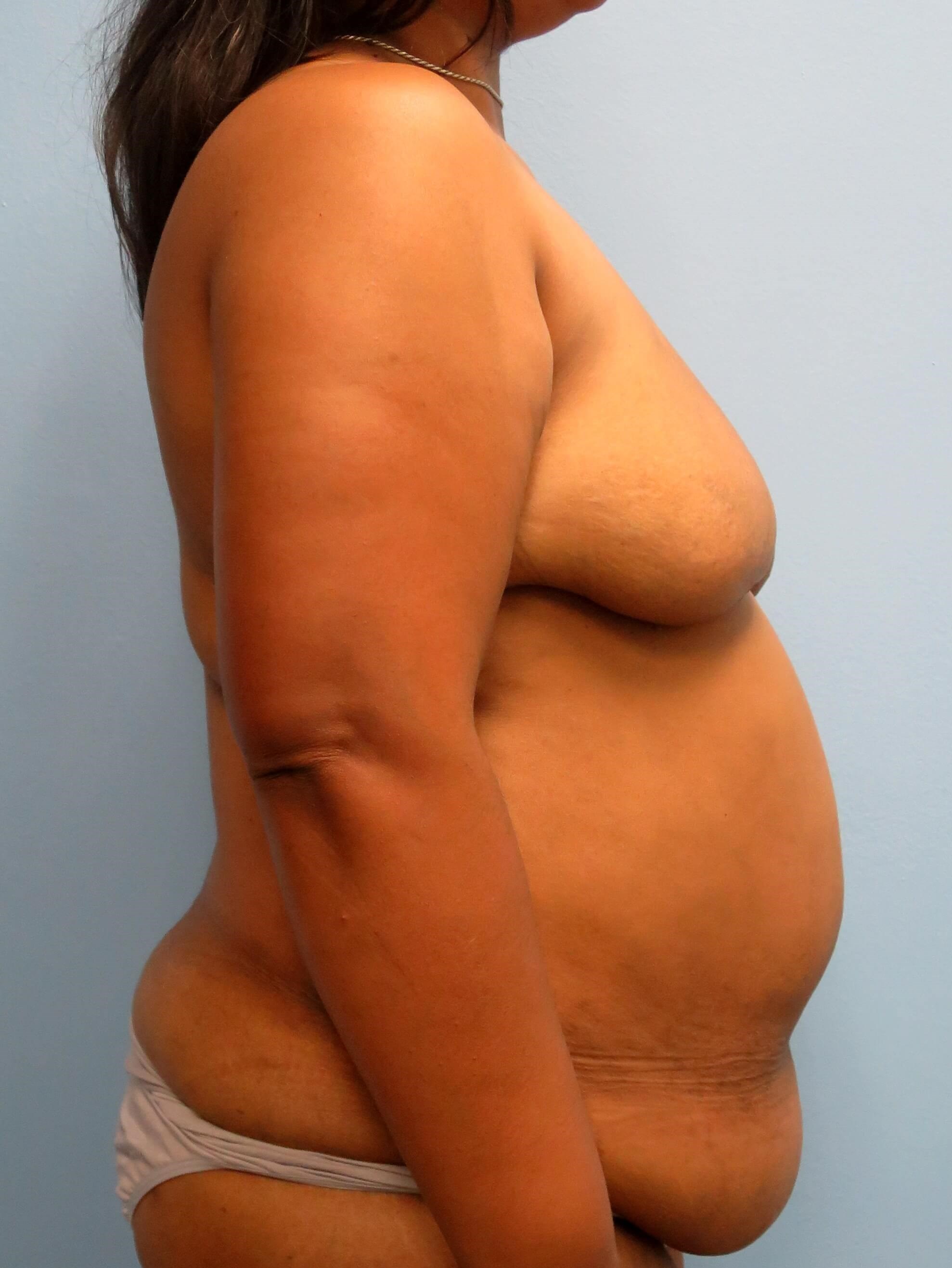 BRCA DIEP Flap Reconstruction Before Bilateral DIEP Flaps