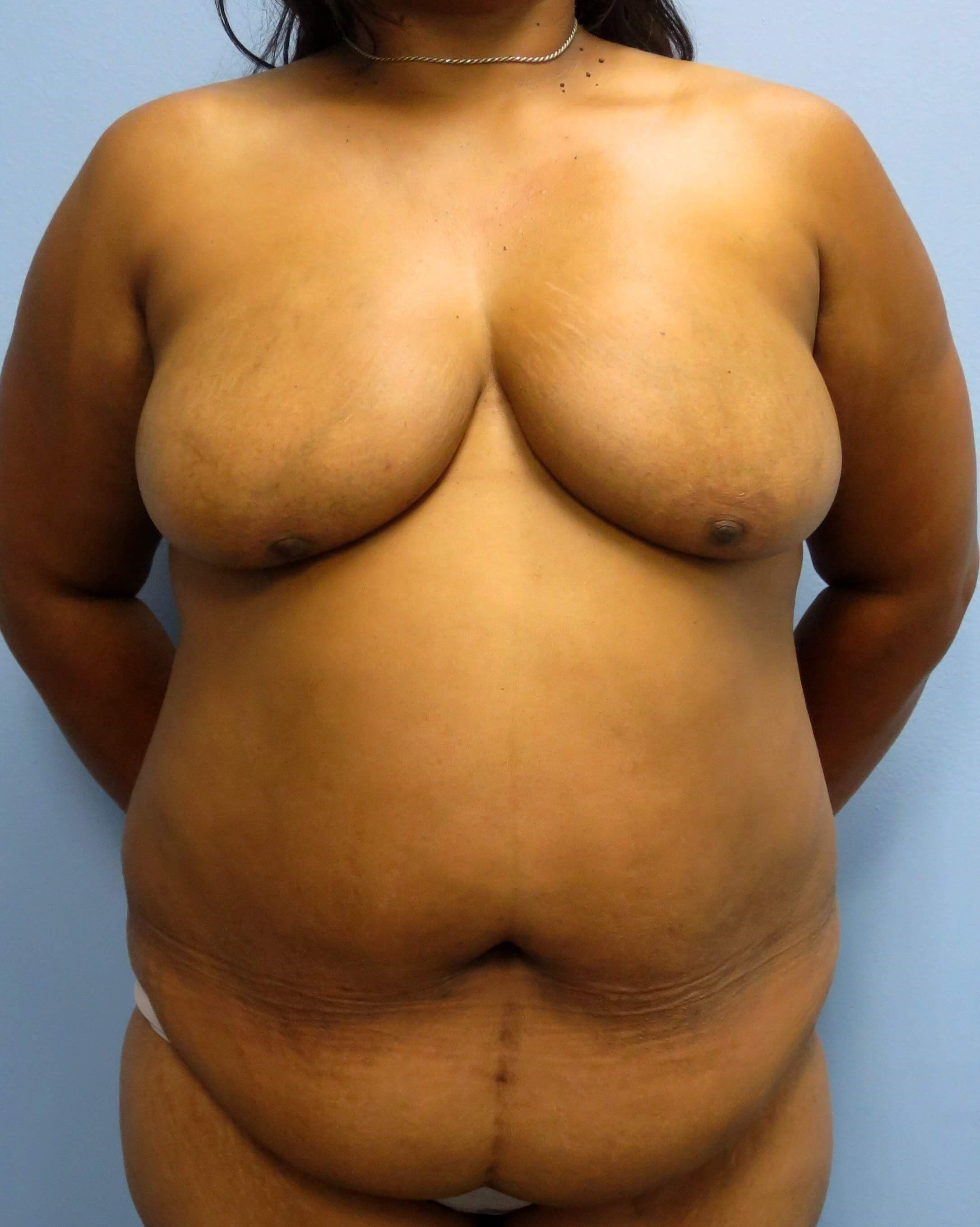 BRCA DIEP Flap Reconstruction Before Bilateral DIEP Flaps