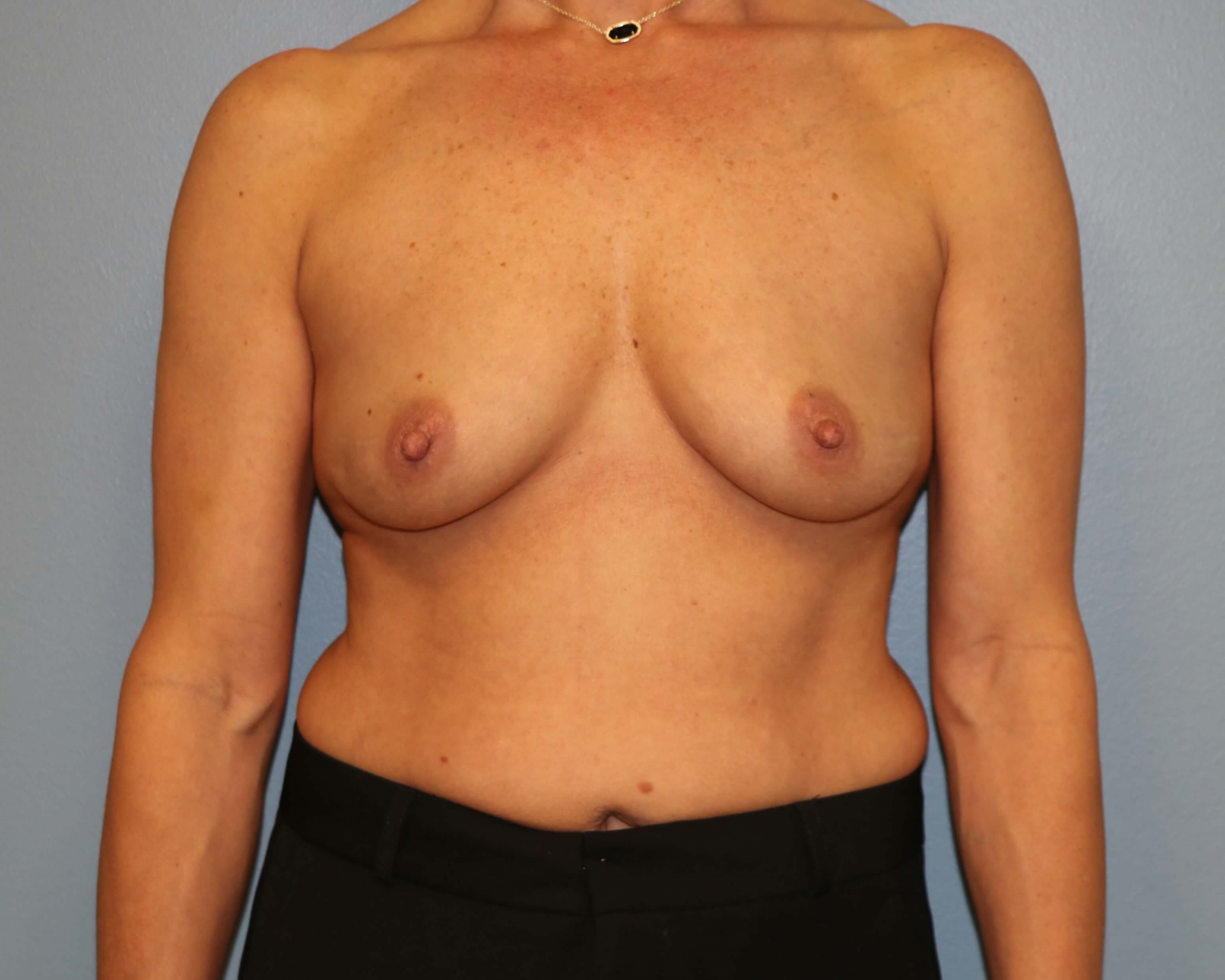 DIEP Flap Before & After Before DIEP Flaps
