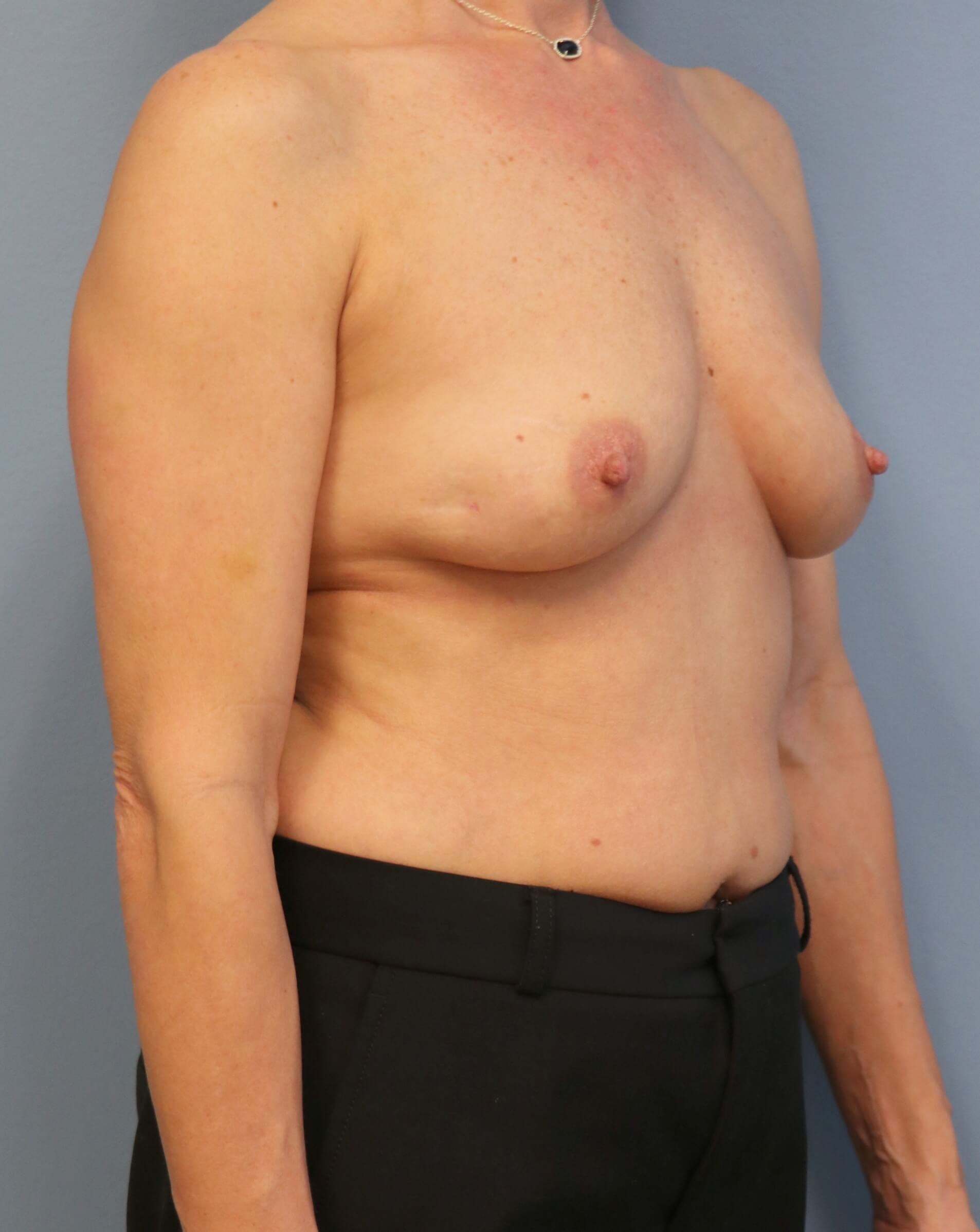 DIEP Flap Before & After Before DIEP Flaps