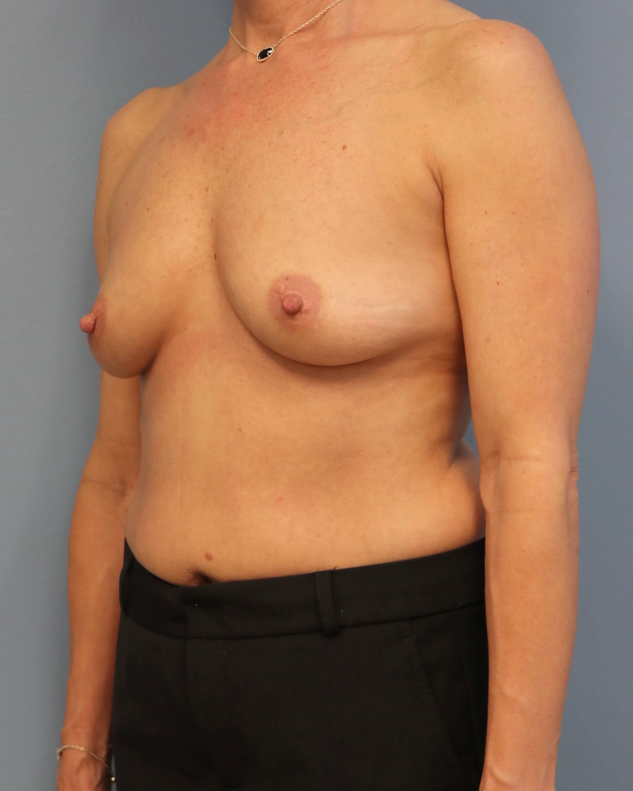 DIEP Flap Before & After Before DIEP Flaps