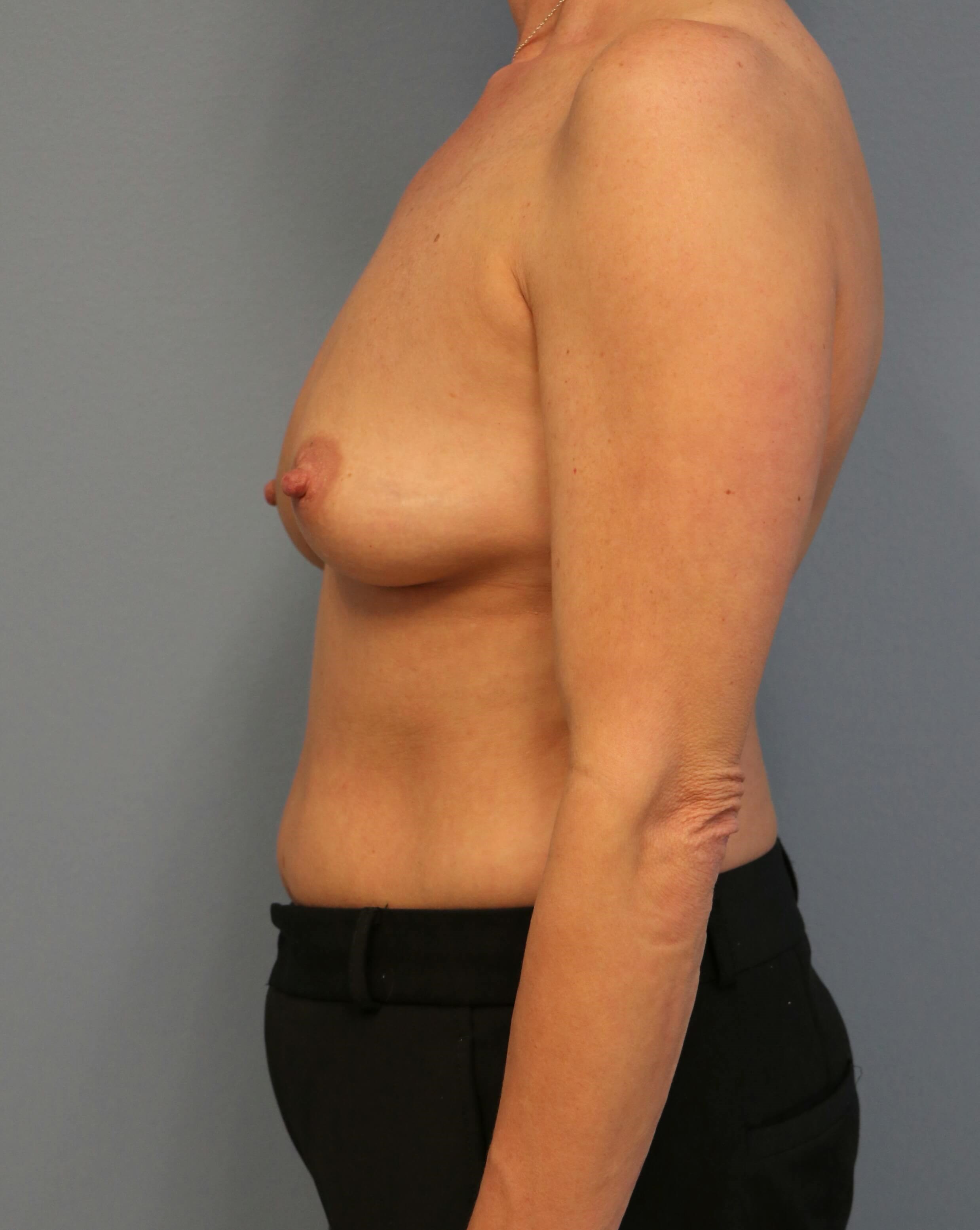 DIEP Flap Before & After Before DIEP Flaps