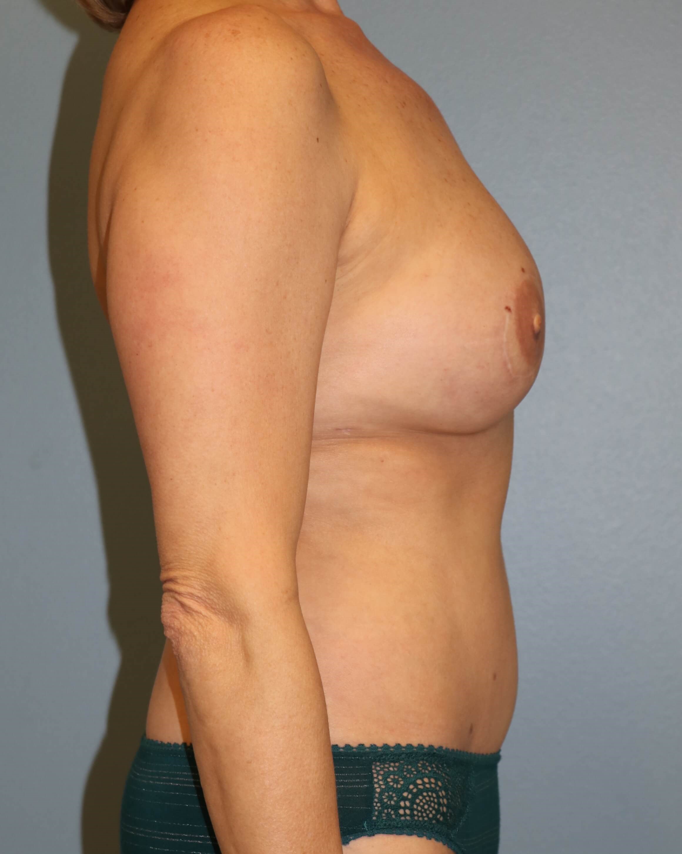 DIEP Flap Before & After After DIEP Flaps