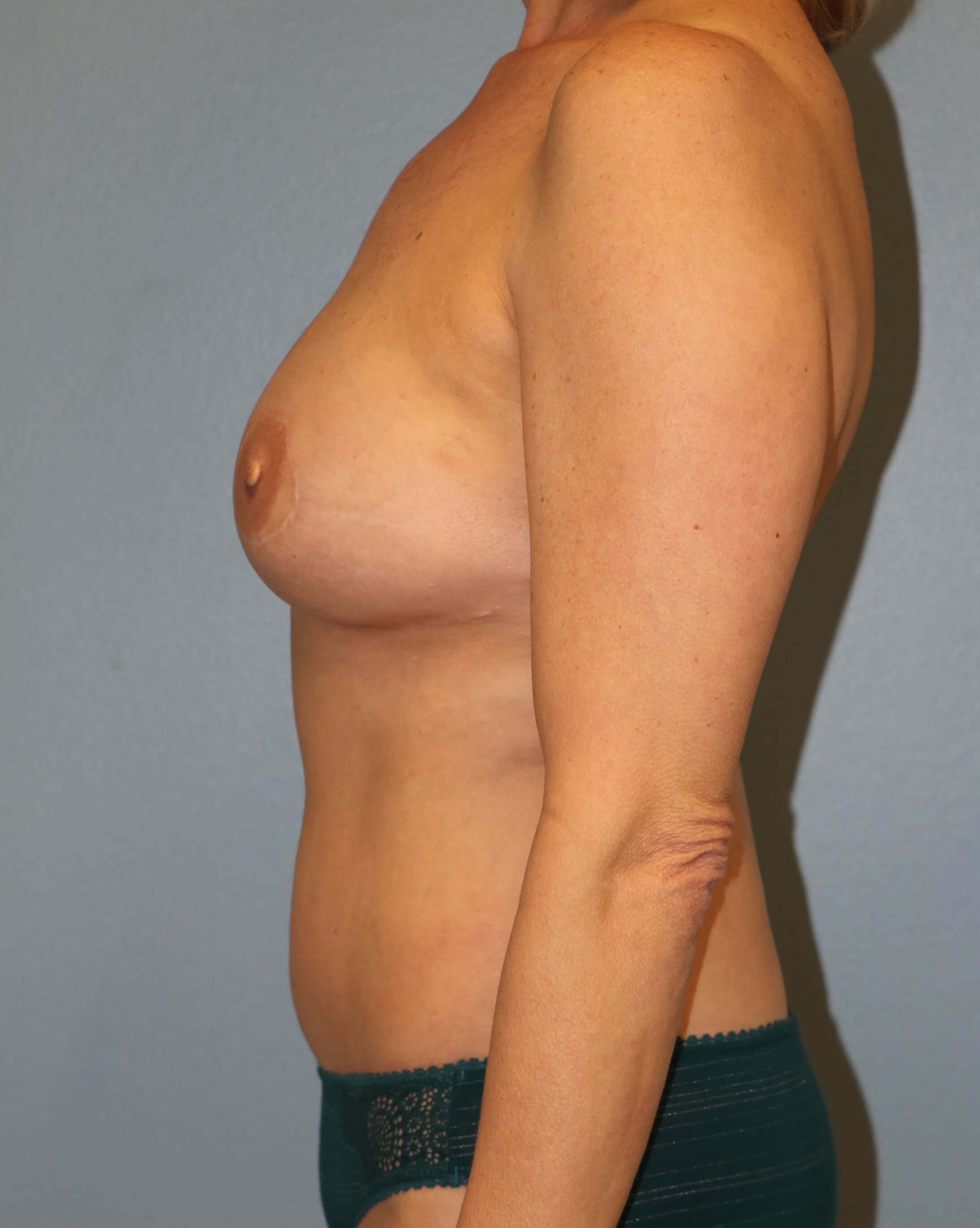 DIEP Flap Before & After After DIEP Flaps