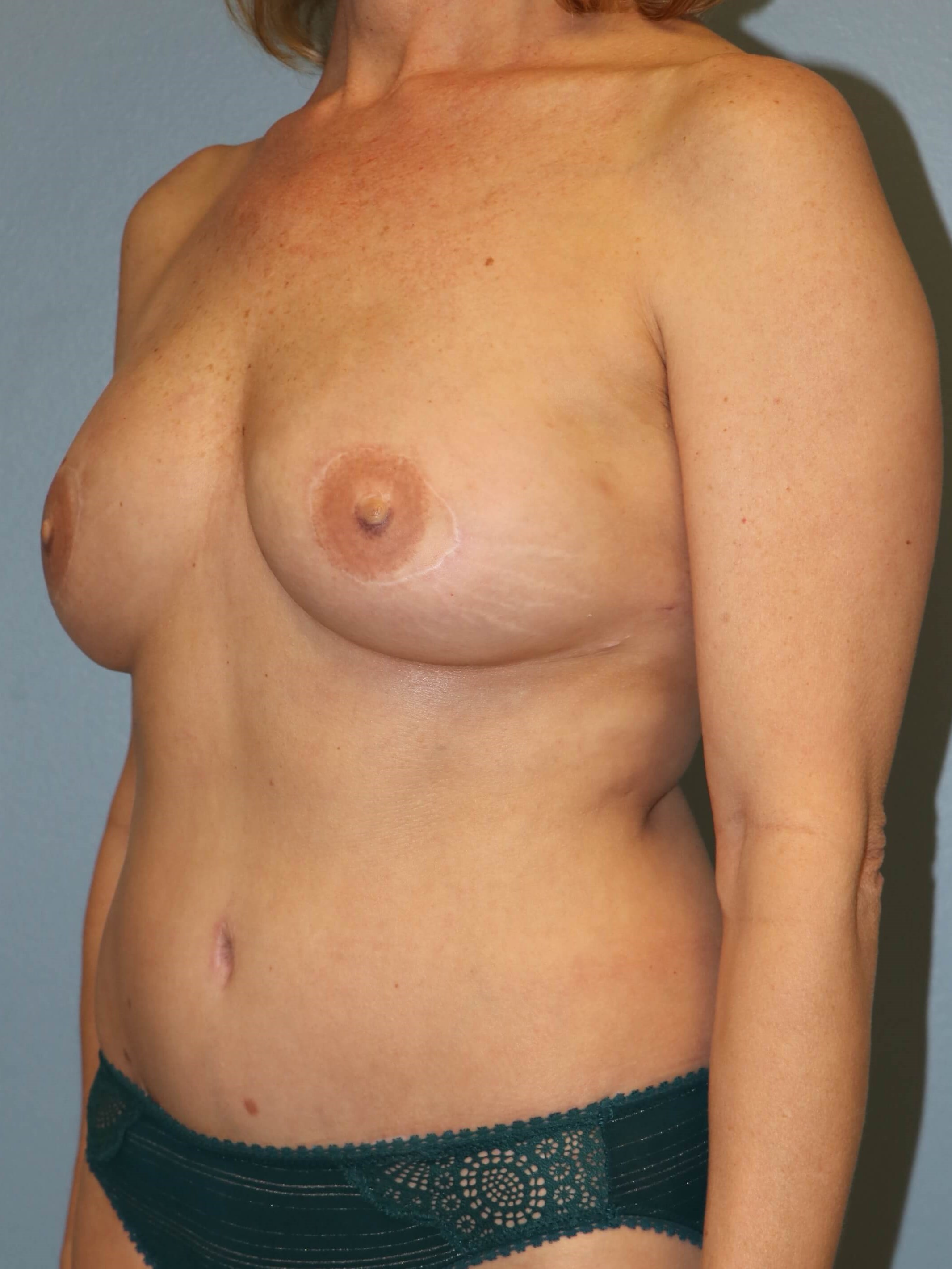 DIEP Flap Before & After After DIEP Flaps