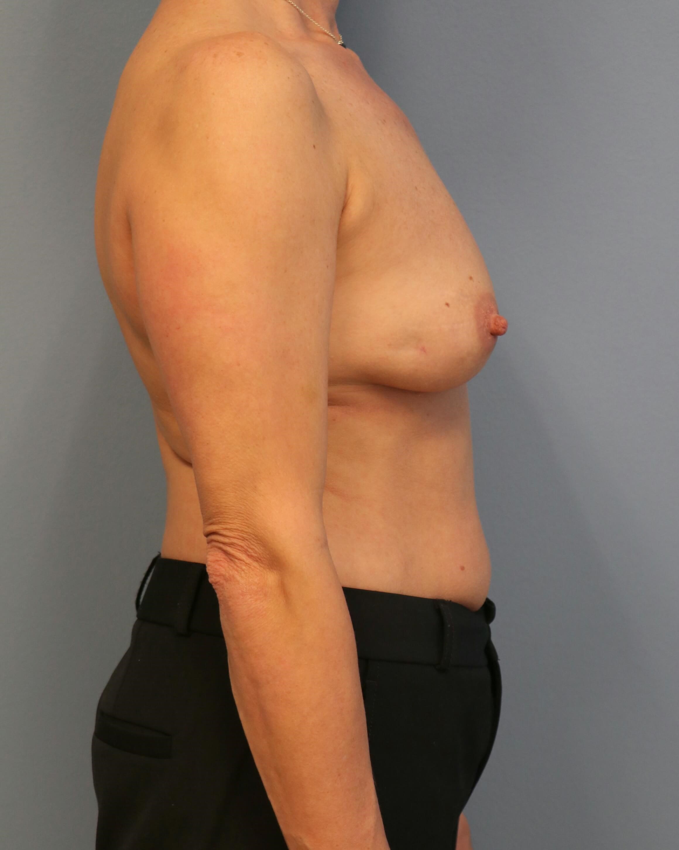 DIEP Flap Before & After Before DIEP Flaps