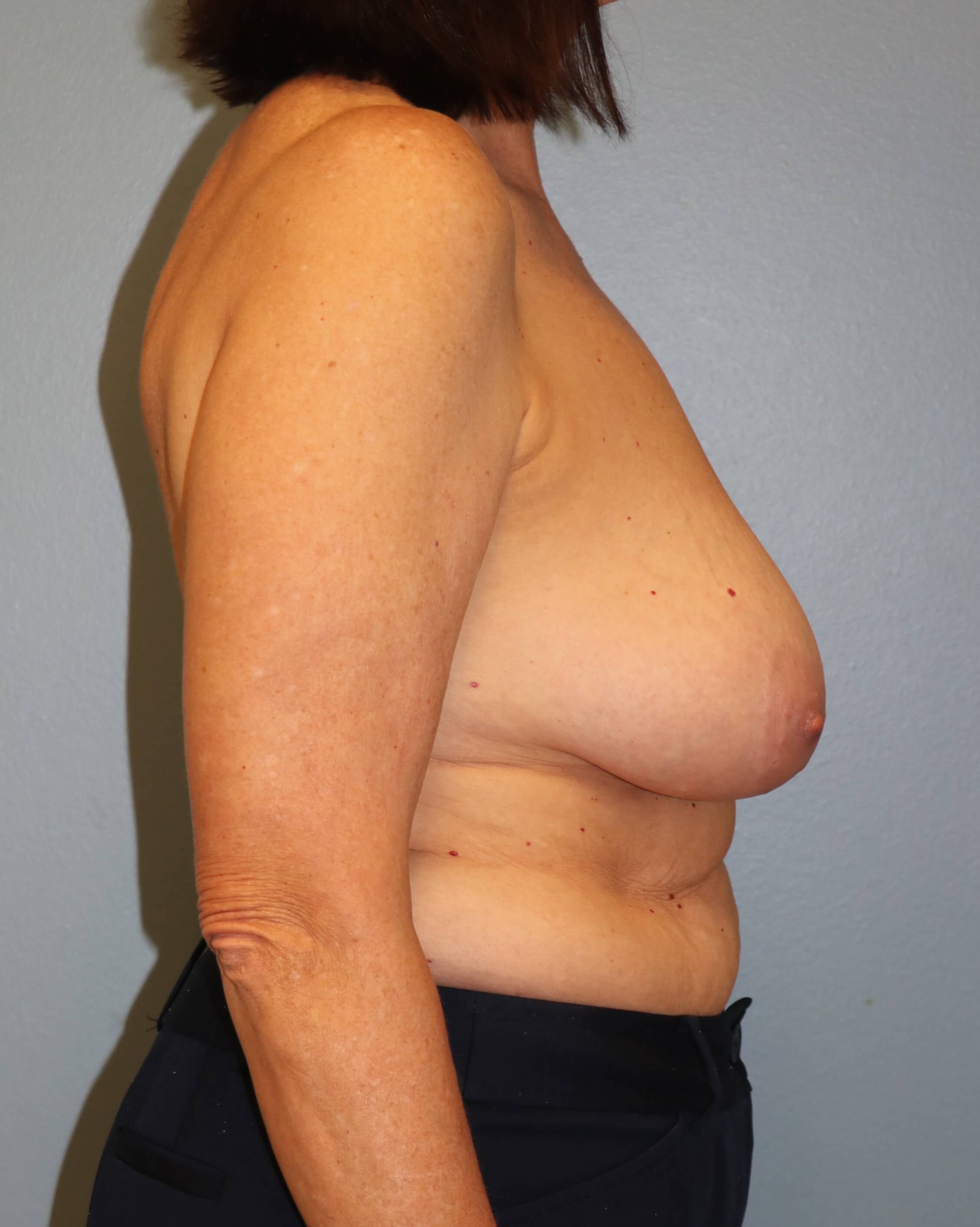 Oncoplastic Mastopexy Results Before Breast Lift