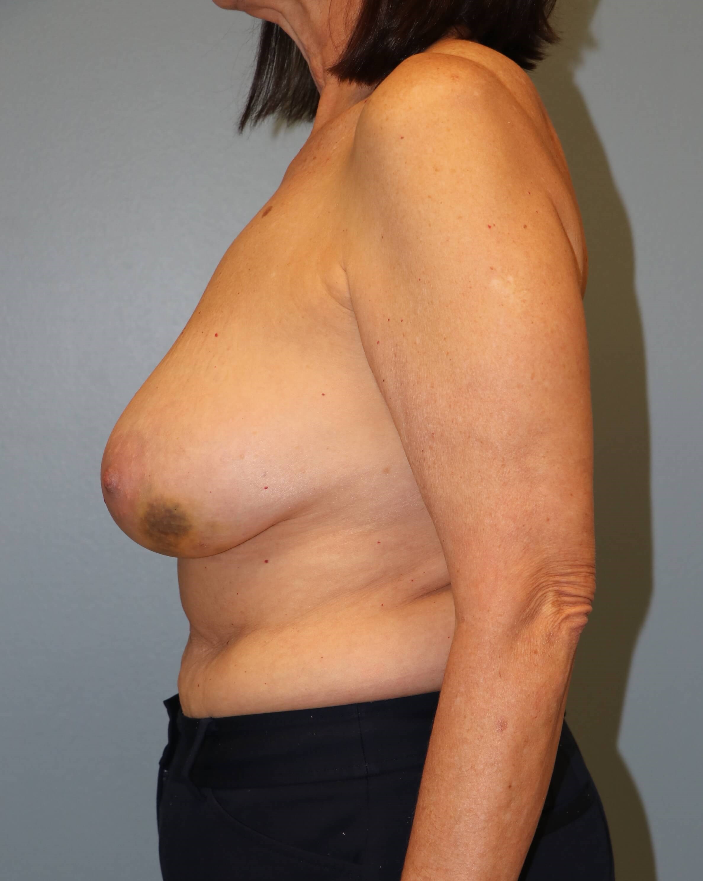 Oncoplastic Mastopexy Results Before Breast Lift