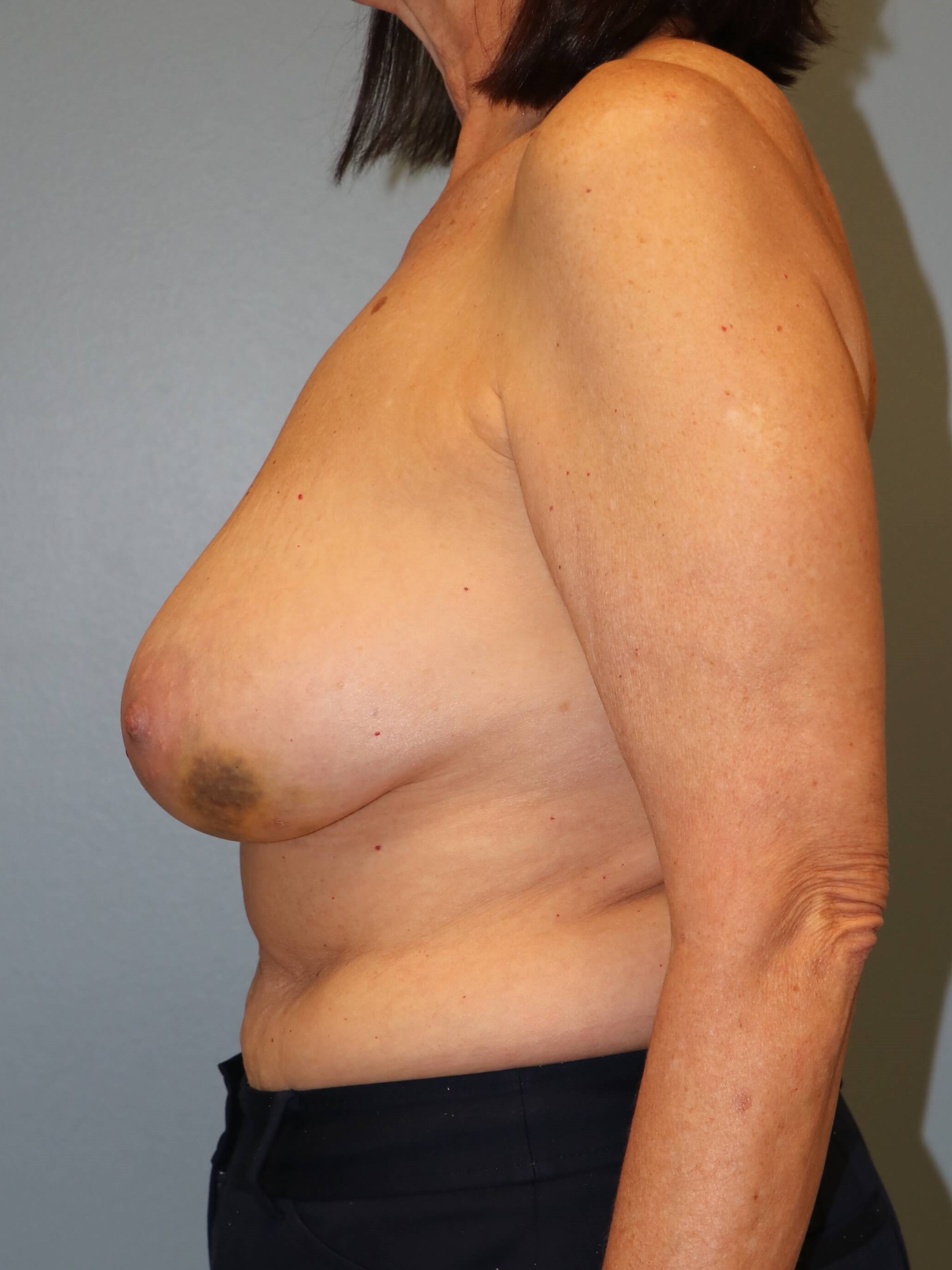 Oncoplastic Mastopexy Results Before Breast Lift