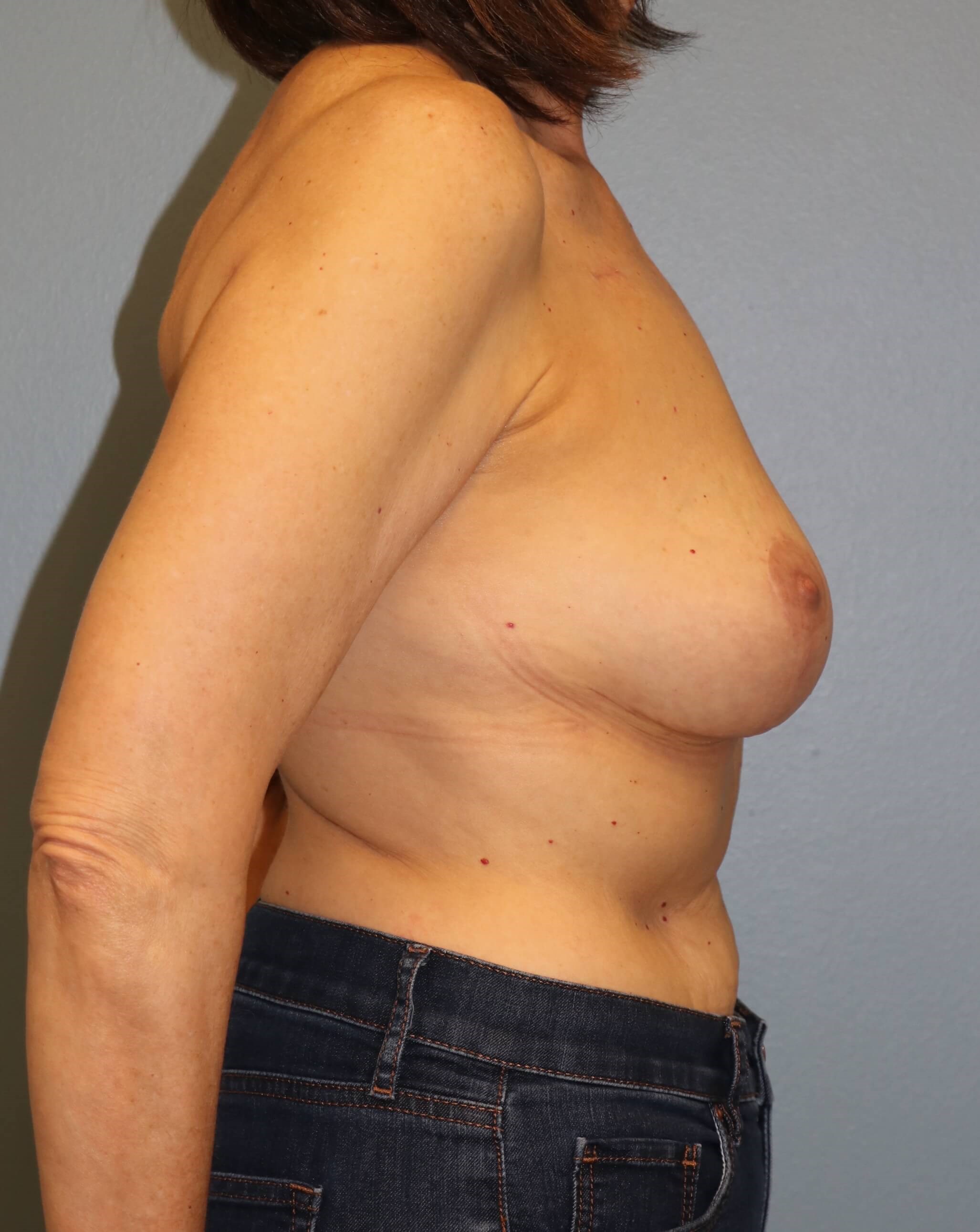 Oncoplastic Mastopexy Results After Breast Lift