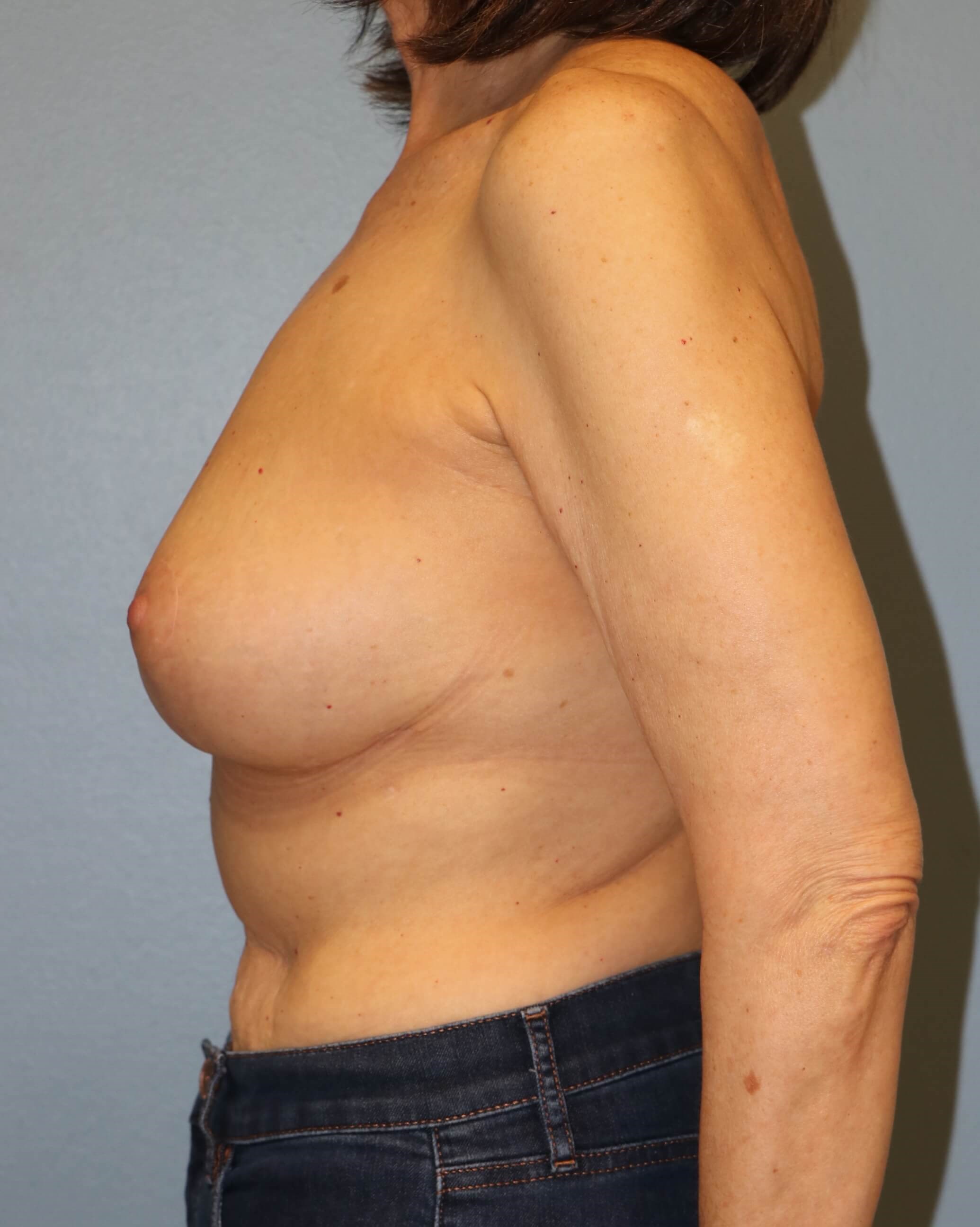 Oncoplastic Mastopexy Results After Breast Lift
