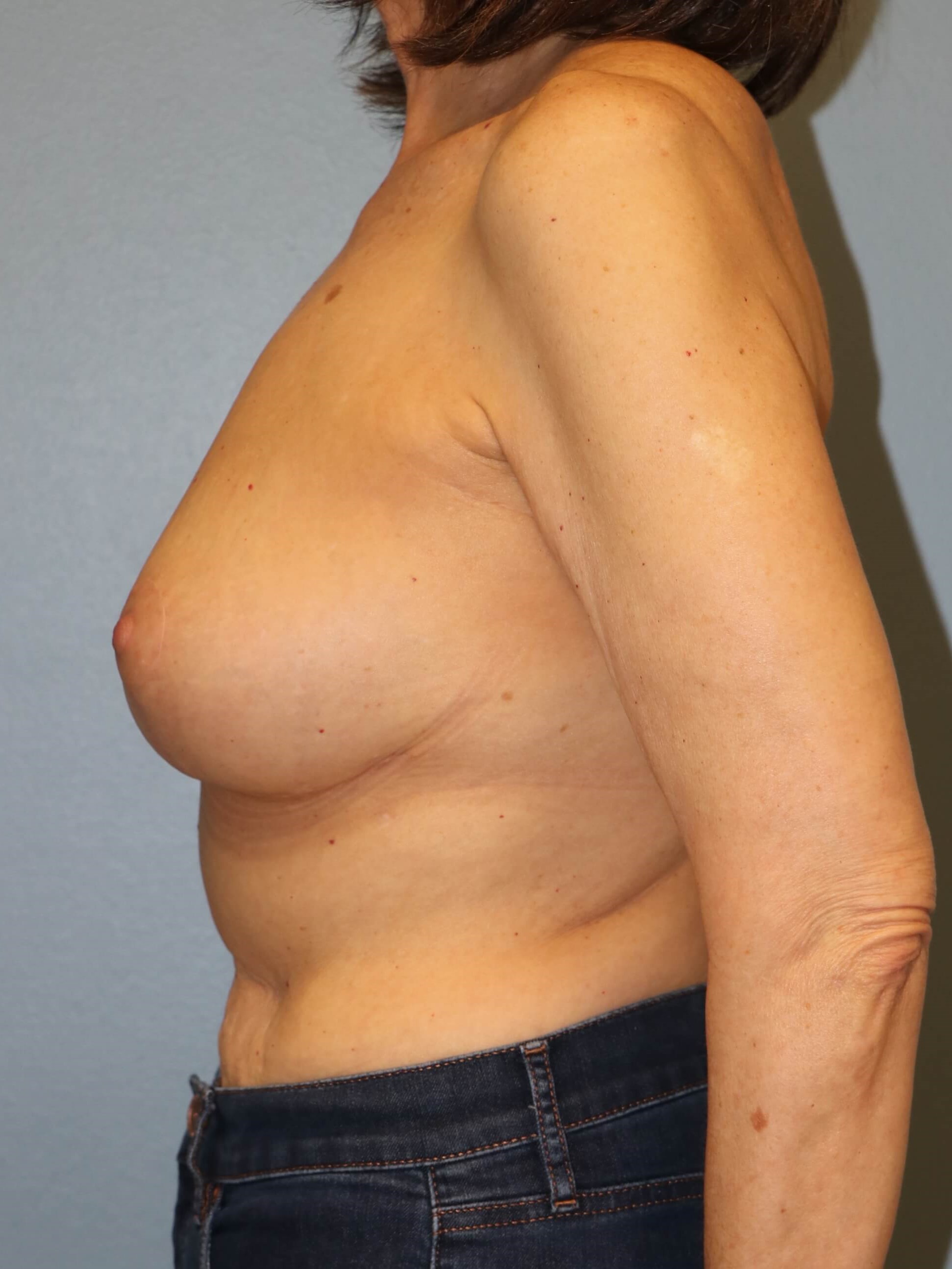 Oncoplastic Mastopexy Results After Breast Lift