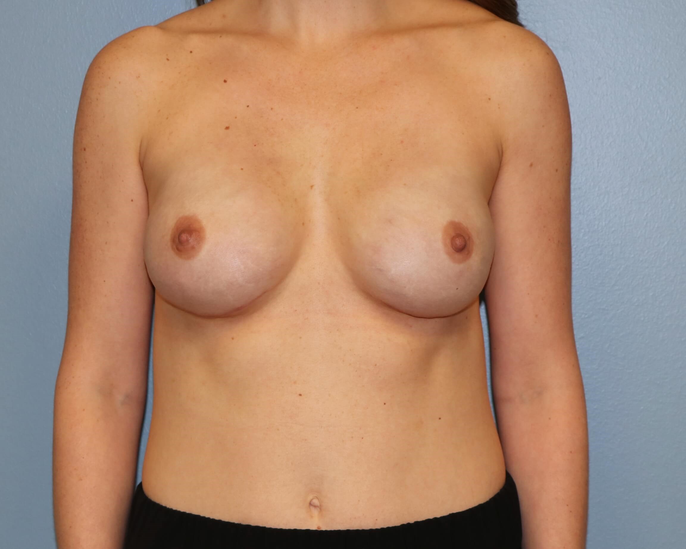Implant Reconstruction Results After Implant Reconstruction