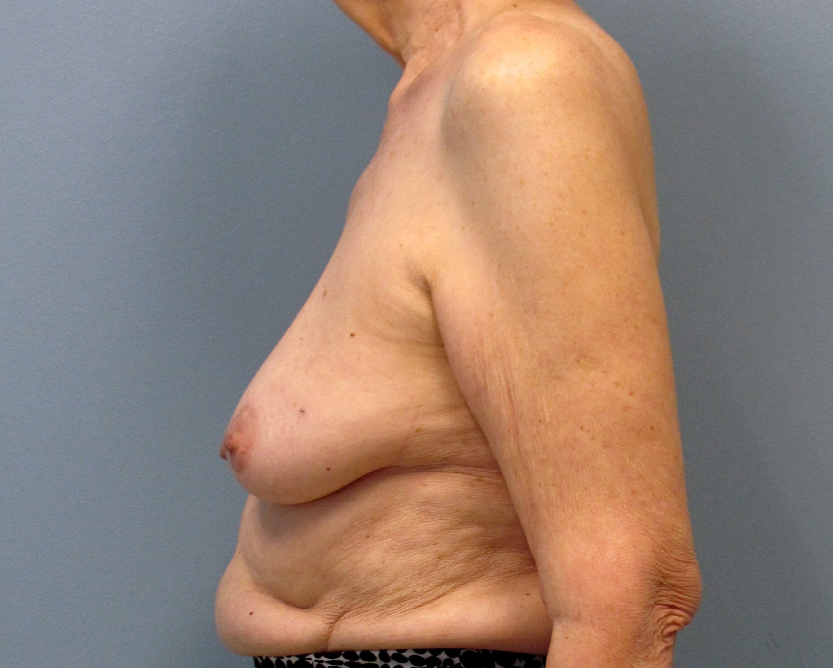 Direct-to-Implant Before/After Before Implant Reconstruction