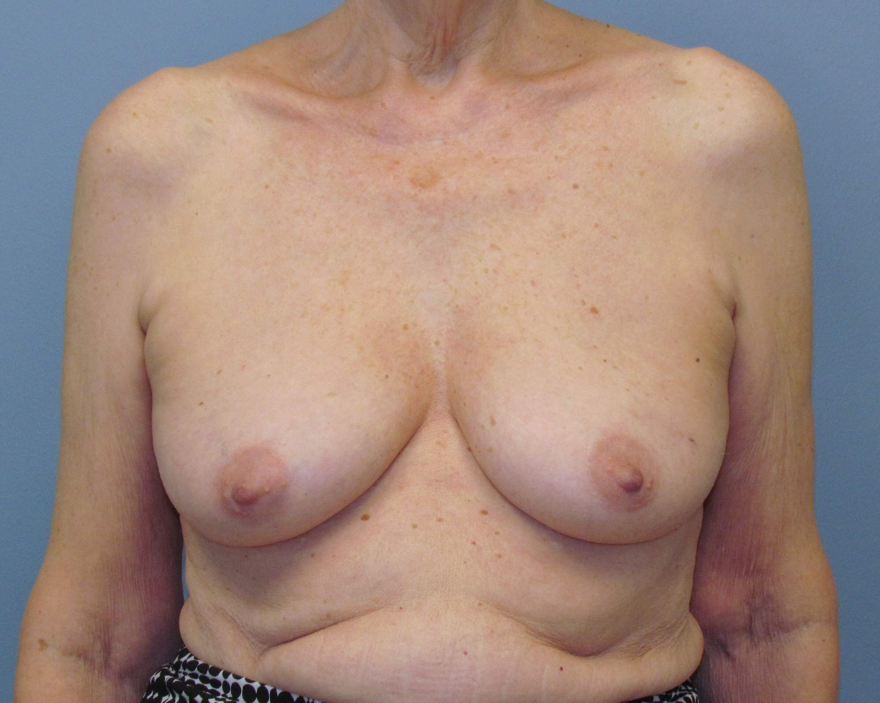 Direct-to-Implant Before/After Before Implant Reconstruction
