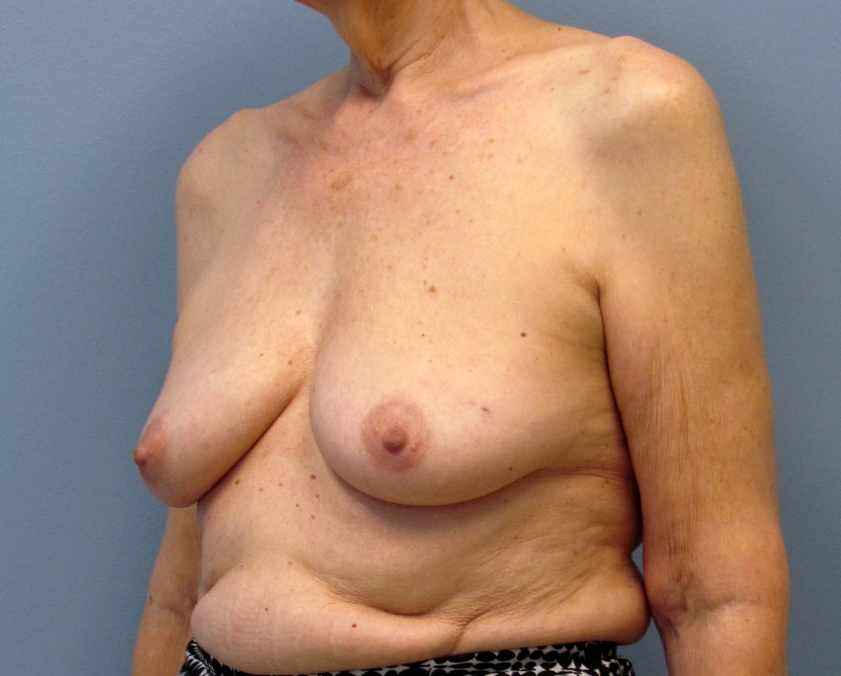 Direct-to-Implant Before/After Before Implant Reconstruction