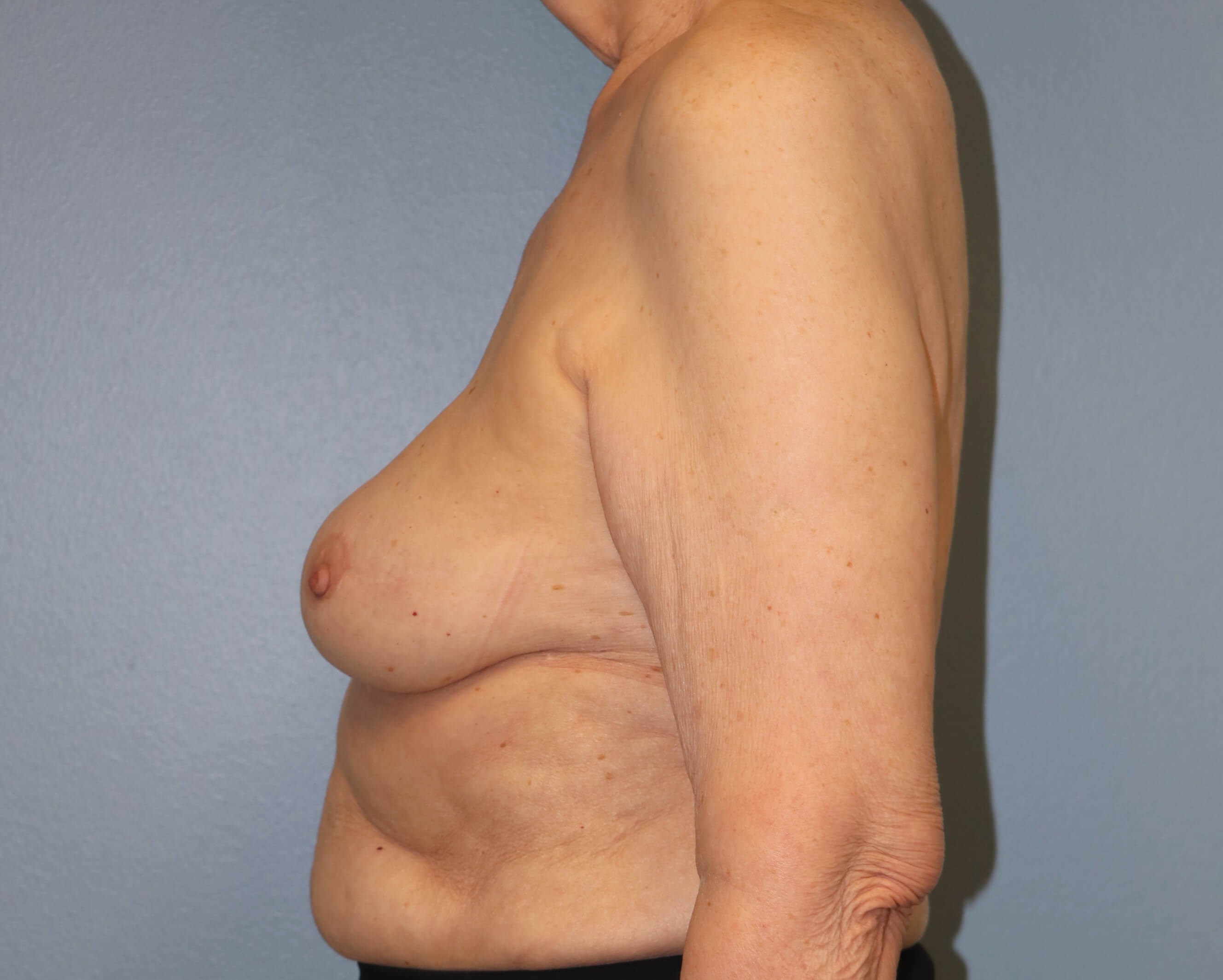 Direct-to-Implant Before/After After Implant Reconstruction