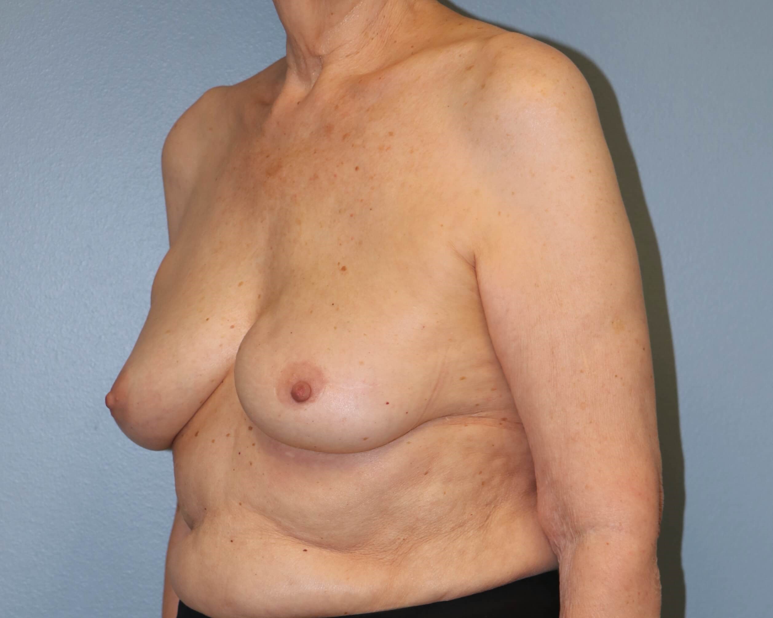 Direct-to-Implant Before/After After Implant Reconstruction