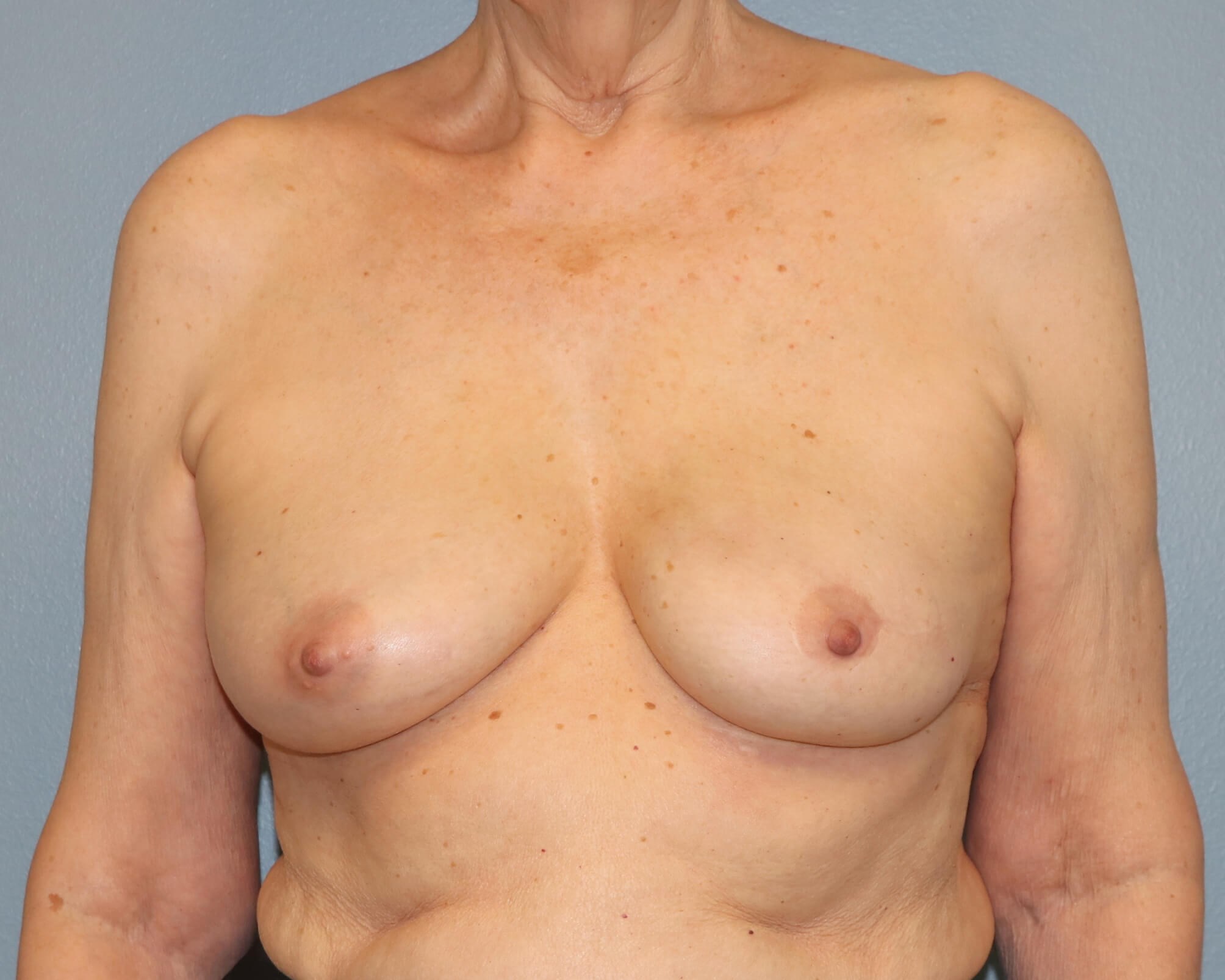 Direct-to-Implant Before/After After Implant Reconstruction