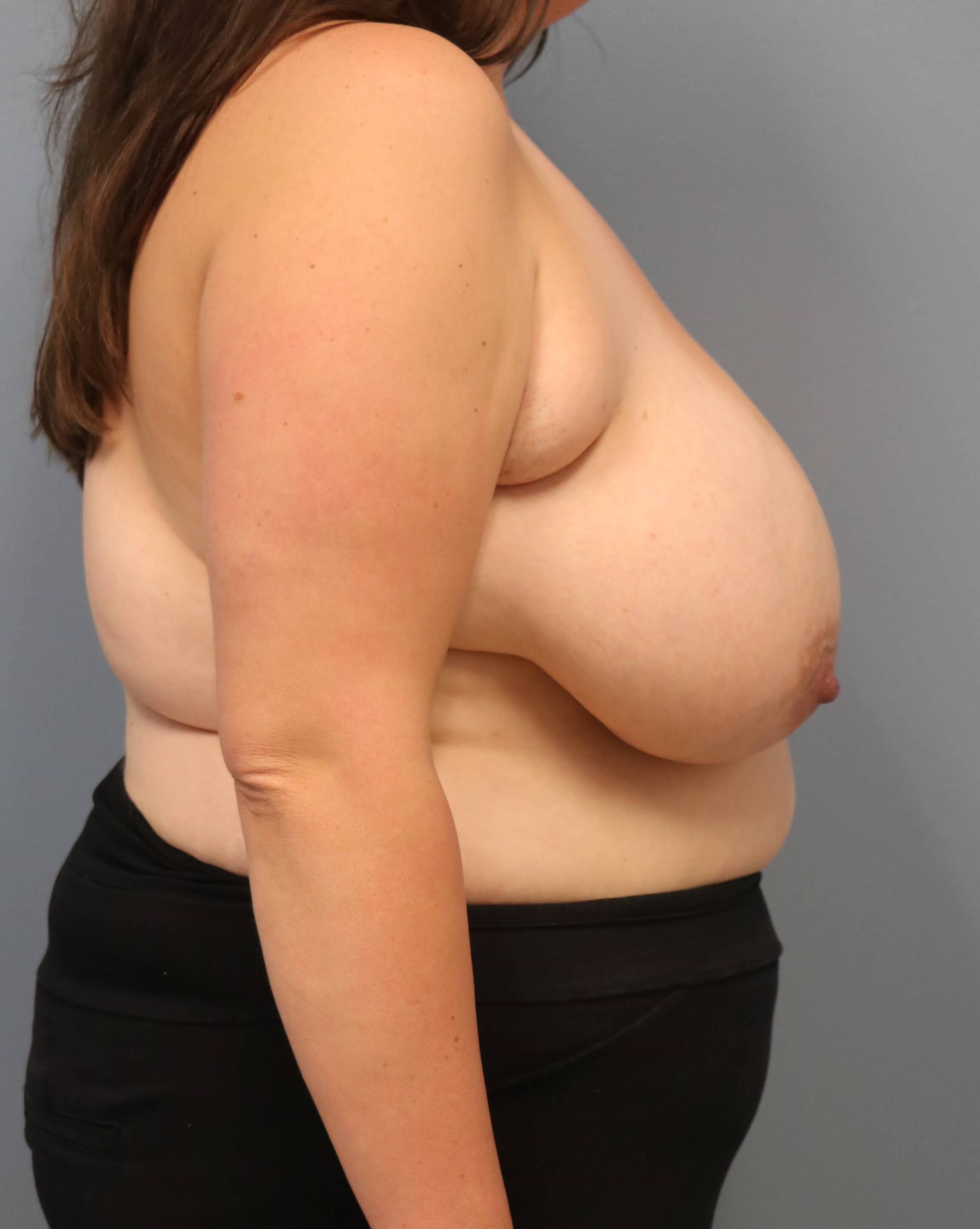 Bilateral Breast Reduction Before Breast Reduction