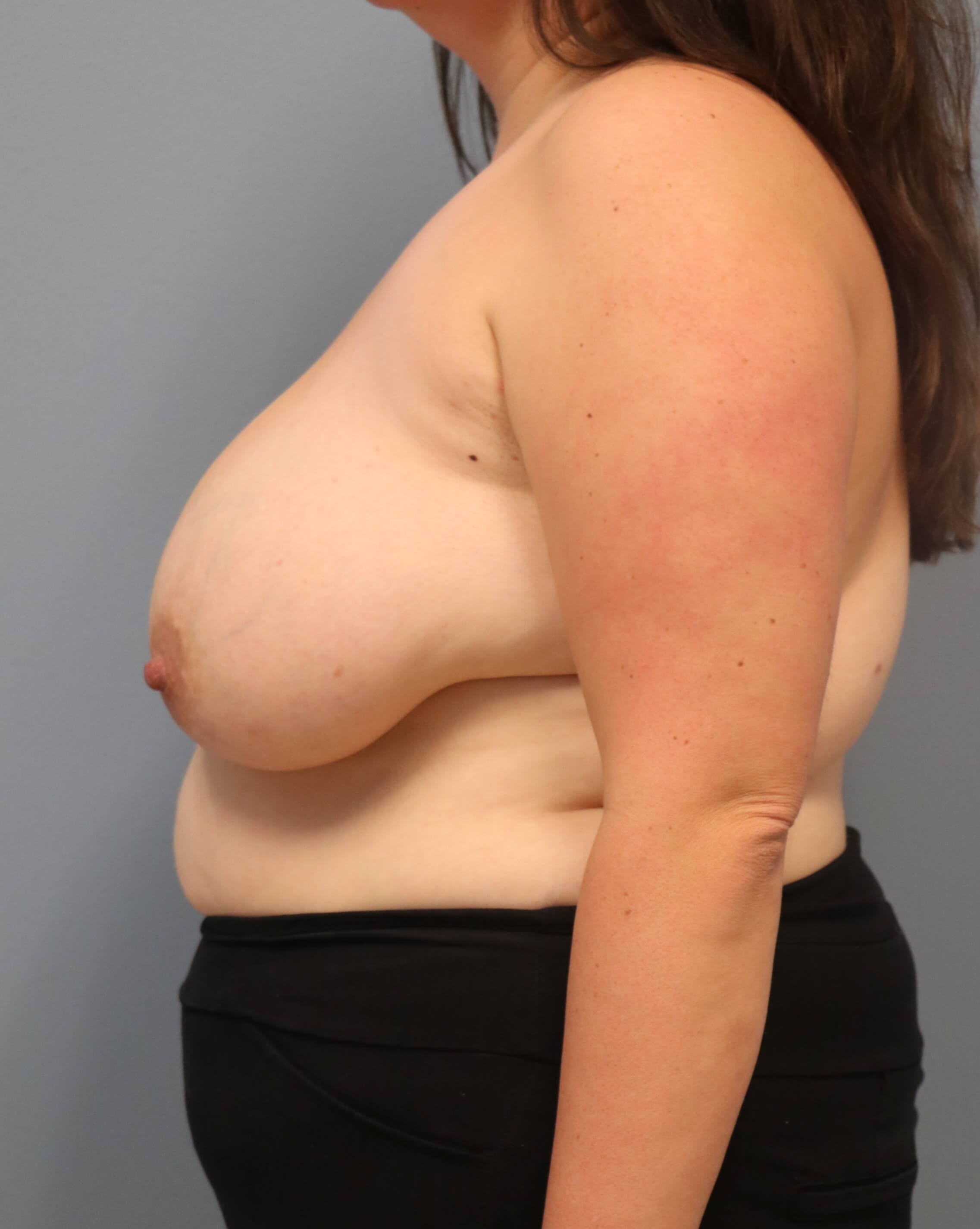 Bilateral Breast Reduction Before Breast Reduction