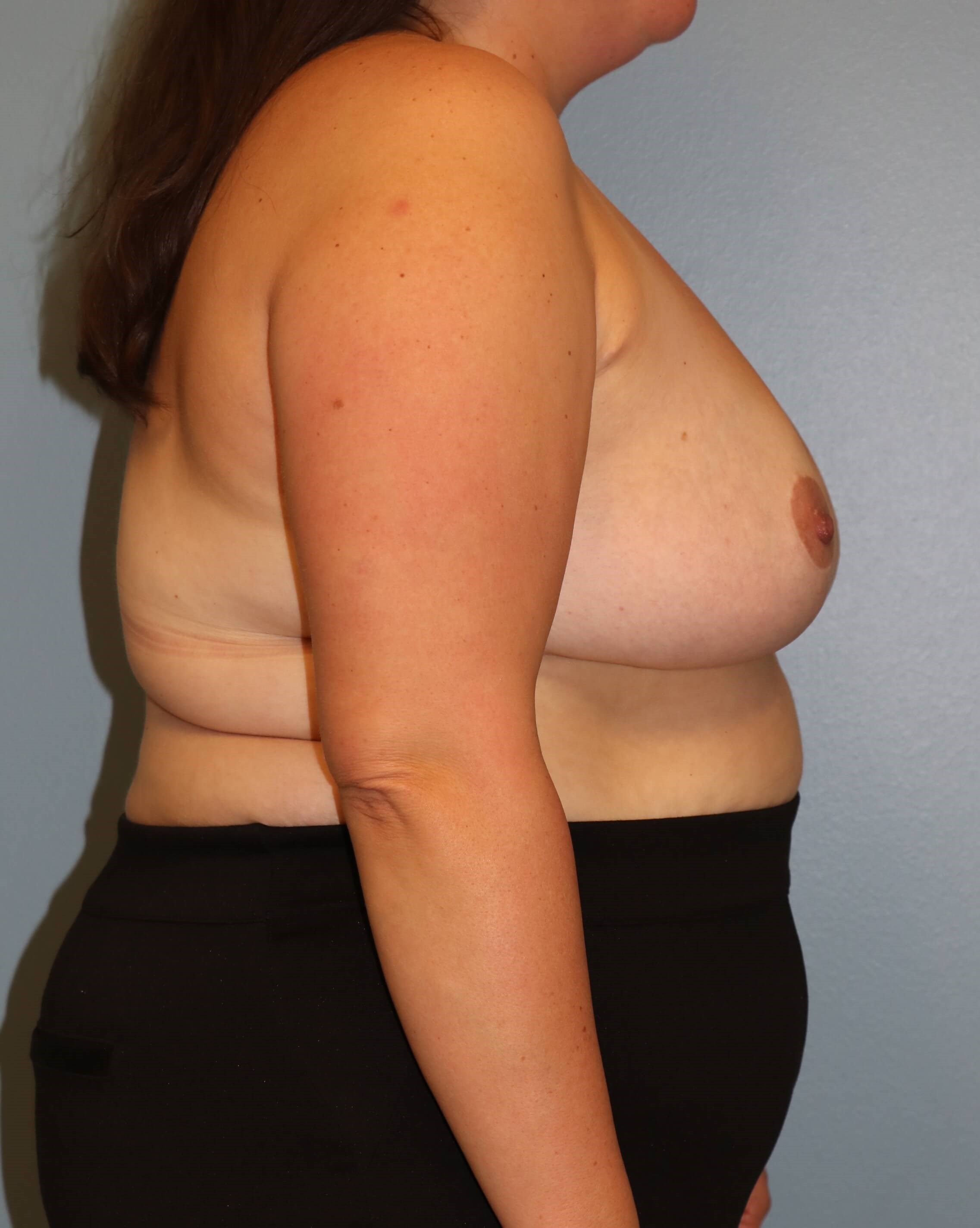 Bilateral Breast Reduction After Breast Reduction