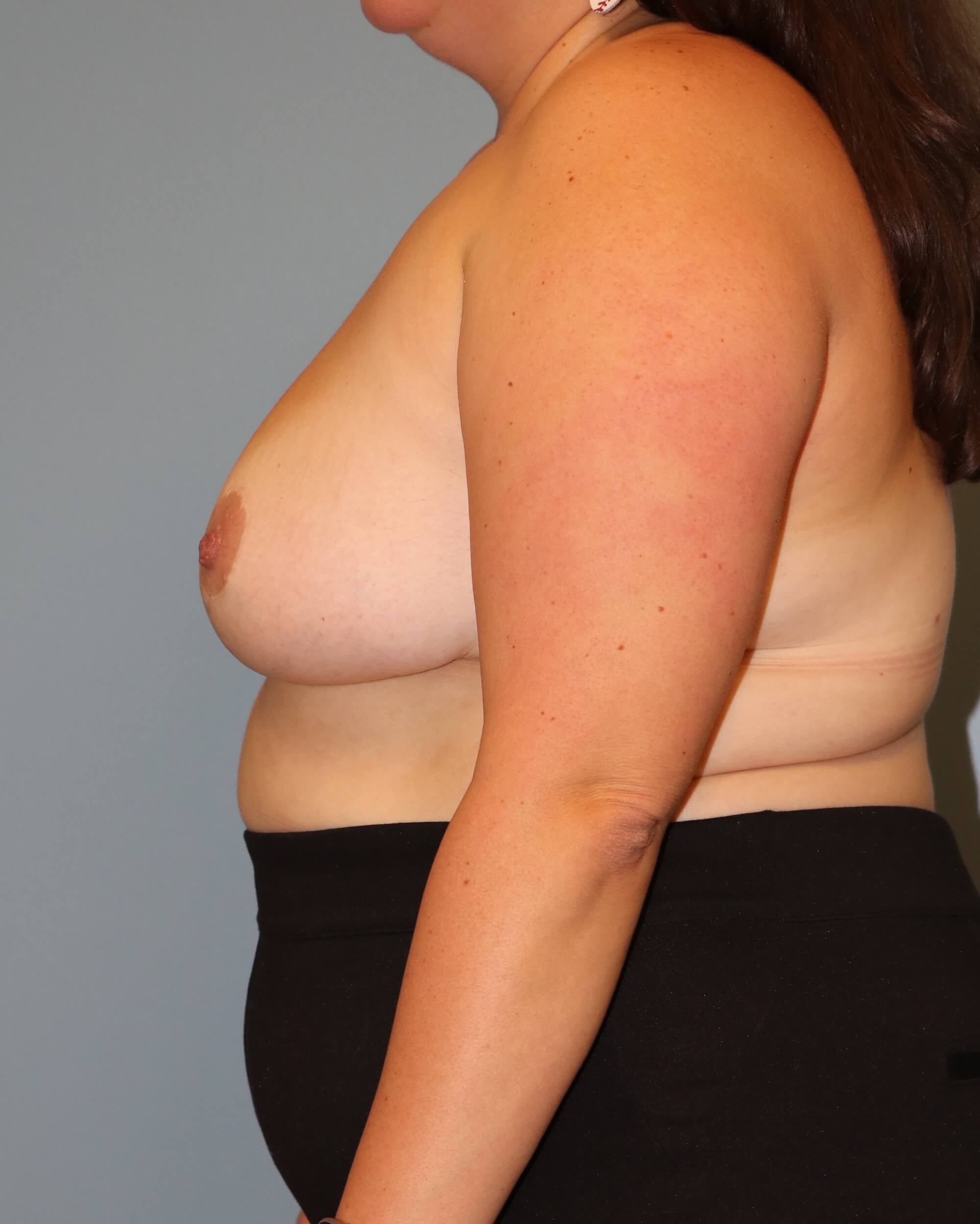 Bilateral Breast Reduction After Breast Reduction