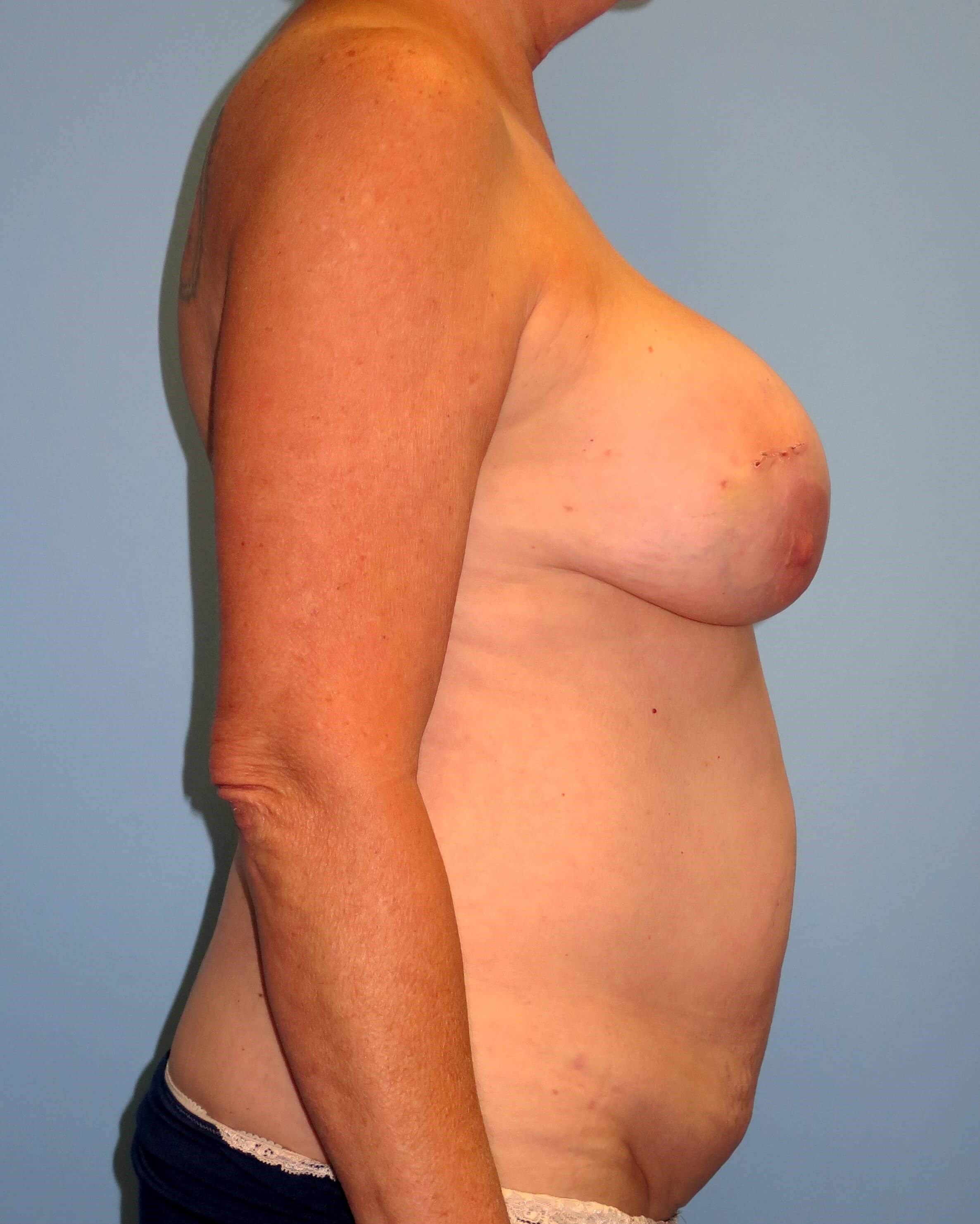 DIEP Flaps Replace Implants Before Lumpectomy