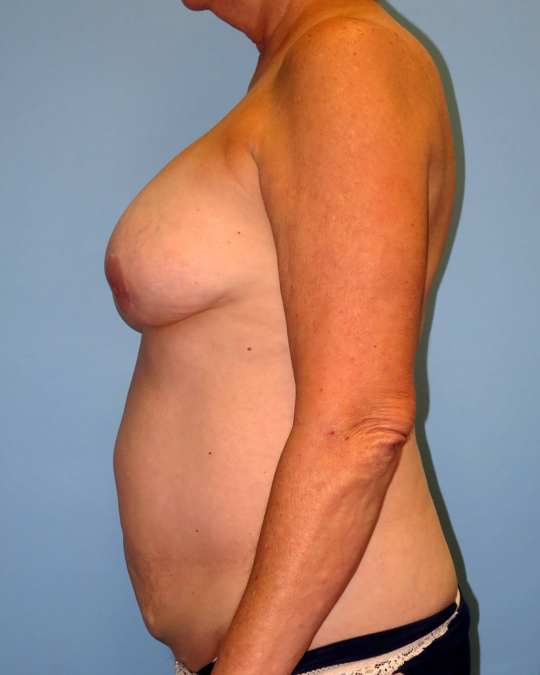 DIEP Flaps Replace Implants Before Lumpectomy