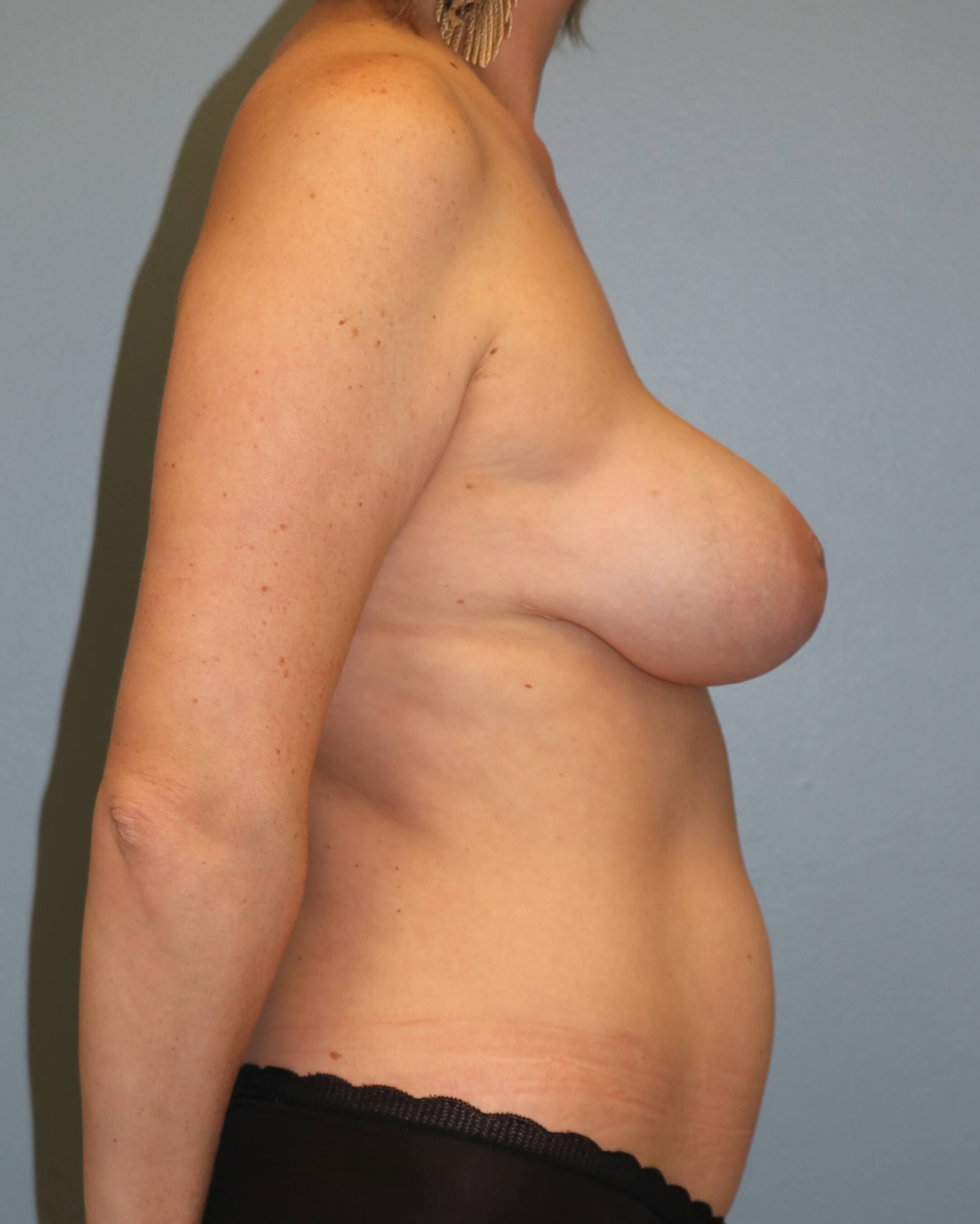 Prepectoral Implant Recon After Implant Reconstruction