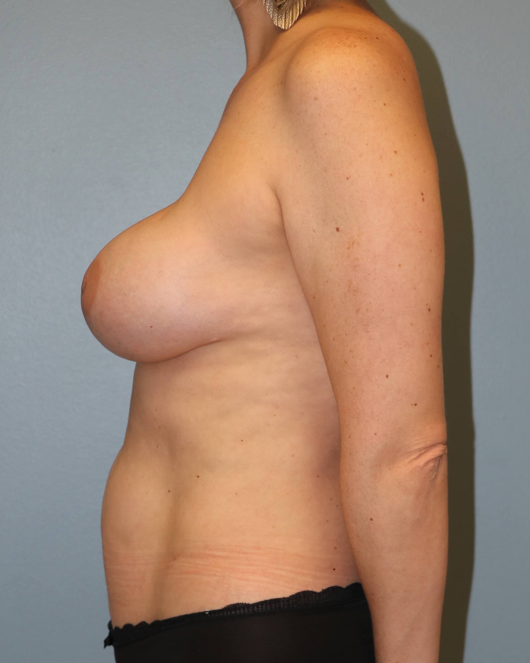 Prepectoral Implant Recon After Implant Reconstruction