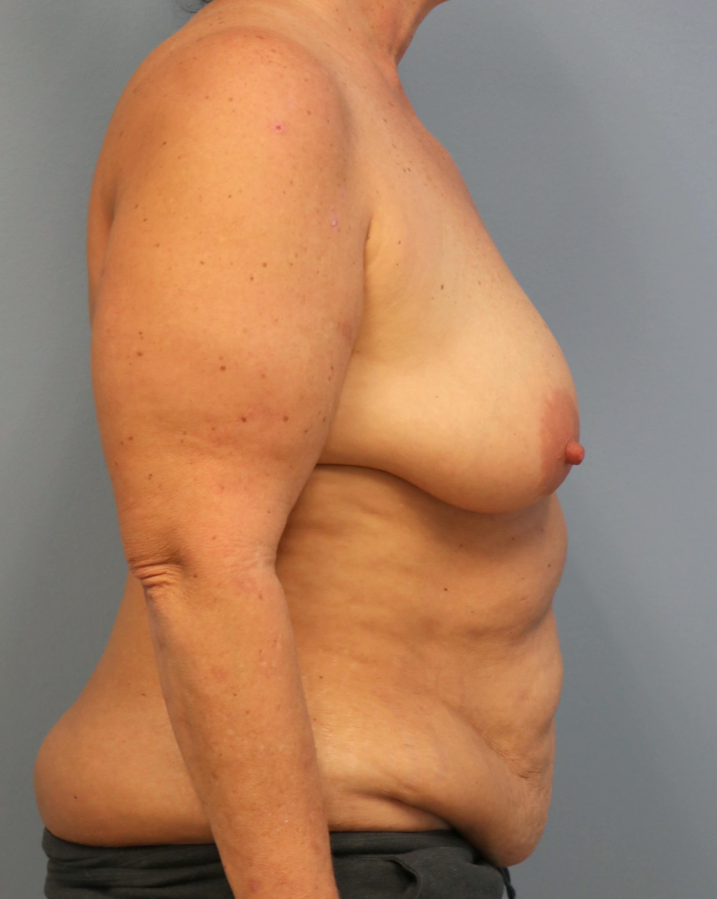 DIEP Flaps with ReSensation Before Bilateral DIEP Flaps