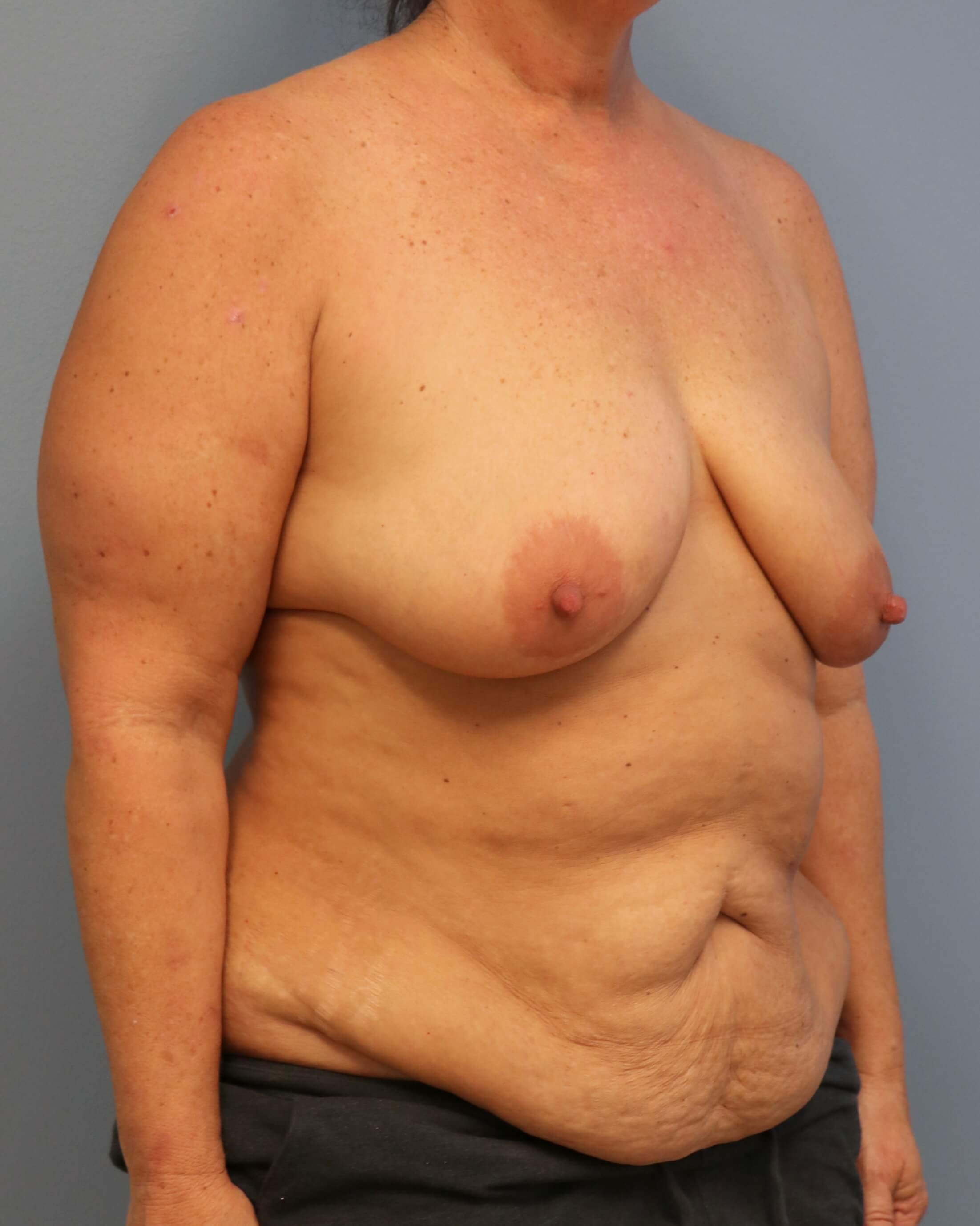 DIEP Flaps with ReSensation Before Bilateral DIEP Flaps